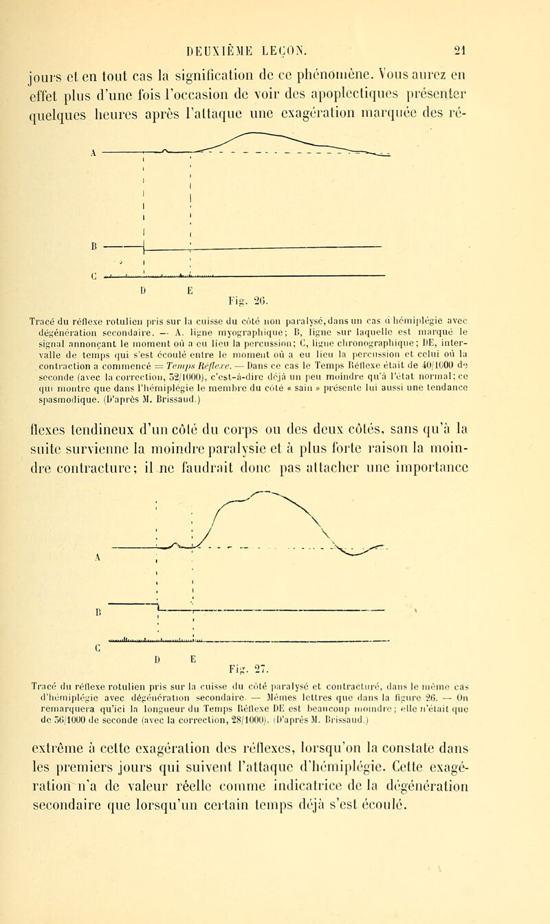 jours et en tout cas la signification de ce phénomène. Vous aurez en effet plus d'une fois l'occasion de voir des apoplectiques présenter quelques heures après l'attaque une exagération marquée des ré- Fig. 2G. Tracé du réflexe rotulieii pris sur la cuisse du cote non paralyse, dans un cas d hémiplégie avec dégénération secondaire. — A. ligne myograpliique; B, ligne sur laquelle est marqué le signal annonçant le moment où a eu lieu la percussion; C, ligne clironographique; DE, inter- valle de temps qui s'est écoulé entre le moment où a eu lieu la percussion et celui où la contraction a commencé = Temps Rcflc.re. — Dans ce cas le Temps Réflexe était de 40/1000 de seconde (avec la correction, 52/1000), c'est-à-dire déjà un peu moindre qu'à l'état normal; ce qui montre que dans l'hémiplégie le membre du côté « sain » présente lui aussi une tendance spasmodique. (D'après M. Brissaud.) flexes tendineux d'uncôlé du corps ou des deux côtés, sans qu'à la suite survienne la moindre paralysie et à plus forte l'aison la moin- dre contracture; il ne faudrait donc pas attacher une importance \ D E Fi-. 27. Tracé du réflexe rotulien pris sur la cuisse du coté paralysé et contracture, dans le même cas d'hémiplégie avec dégénération secondaire — îlémes lettres que dans la figure 26. — On remarquera qu'ici la longueur du Temps Réflexe DE est beaucoup monidro; elle n'était que de 56/1000 de seconde (avec la correction, 28/1000). (D'après M. Brissaud.) extrême à cette exagération des réflexes, lorsqu'on la constate dans les premiers jours qui suivent l'attaque d'hémiplégie. Cette exagé- ration n'a de valeur réelle comme indicatrice de la dégénération secondaire que lorsqu'un certain temps déjà s'est écoulé.