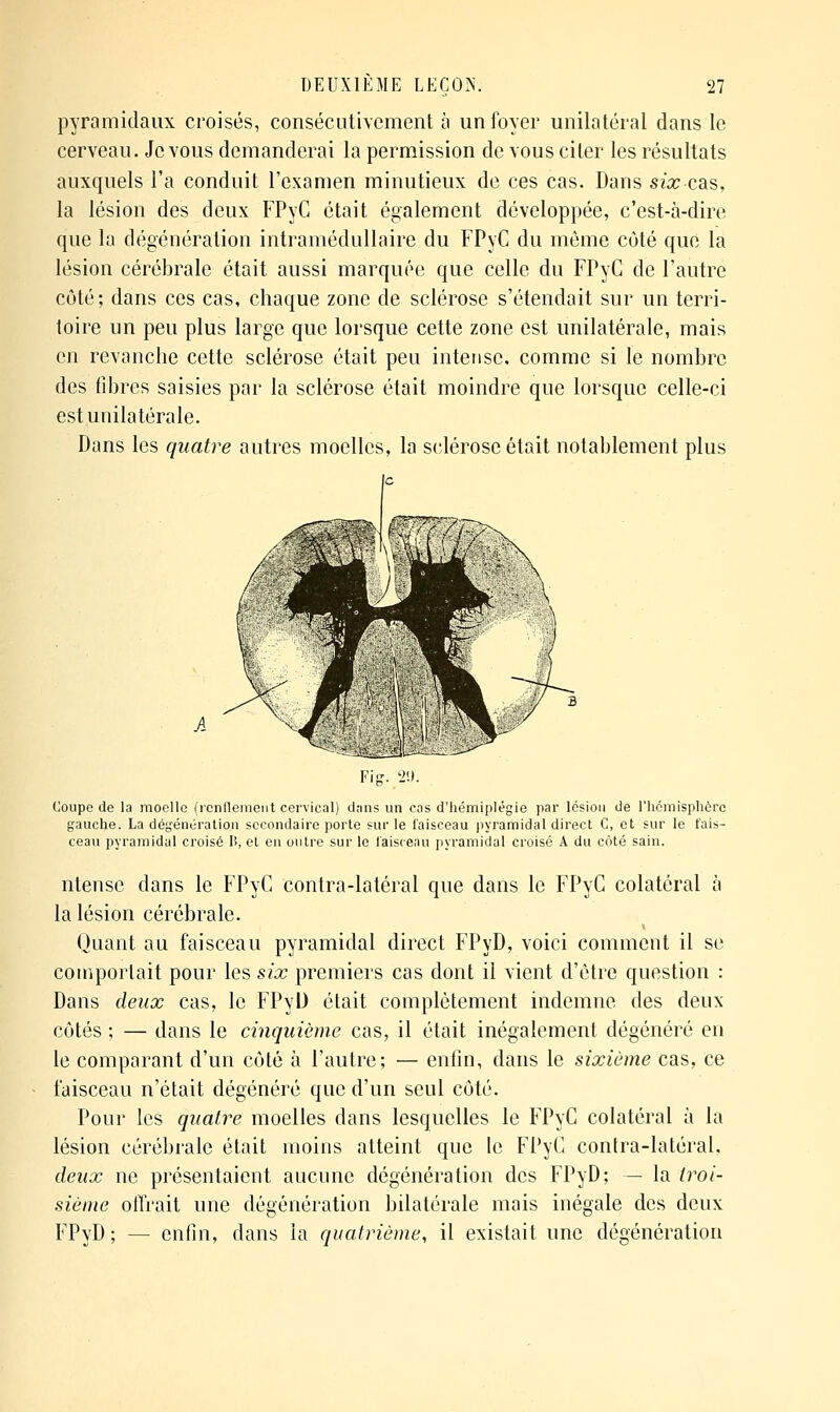 pyramidaux croisés, consécutivement à un foyer unilatéral dans le cerveau. Je vous demanderai la permission de vous citer les résultats auxquels l'a conduit l'examen minutieux de ces cas. Dans six cas, la lésion des deux FPyC était également développée, c'est-à-dire que la dégénération intramédullaire du FPyC du même côté que la lésion cérébrale était aussi marquée que celle du FPyC de l'autre côté; dans ces cas, chaque zone de sclérose s'étendait sur un terri- toire un peu plus large que lorsque cette zone est unilatérale, mais en revanche cette sclérose était peu intense, comme si le nombre des fibres saisies par la sclérose était moindre que lorsque celle-ci est unilatérale. Dans les quatre autres moelles, la sclérose était notablement plus Coupe de la moelle (icnflemeiit cervical) dans un cas d'hémiplégie par lésion de l'hémisphère gauche. La dégénération secondaire porte sur le laisceau pyramidal direct C, et sur le fais- ceau pyramidal croisé lî, et en outre sur le laisceau pyramidal croisé A du côté sain. ntense dans le FPyC contra-latéral que dans le FPyC colatéral à la lésion cérébrale. Quant au faisceau pyramidal direct FPyD, voici comment il se comportait pour les six premiers cas dont il vient d'être question : Dans deux cas, le FPyl) était complètement indemne des deux côtés ; — dans le cinquième cas, il était inégalement dégénéré en le comparant d'un côté à l'autre; — enfin, dans le sixième cas, ce faisceau n'était dégénéré que d'un seul côté. Pour les quatre moelles dans lesquelles le FPyC colatéral à la lésion cérébrale était moins atteint que le FPyC conlra-latéral, deux ne présentaient aucune dégénération des FPyD; — la troi- sième offrait une dégénération bilatérale mais inégale des deux FPyD ; — enfin, dans la quatrième, il existait une dégénération