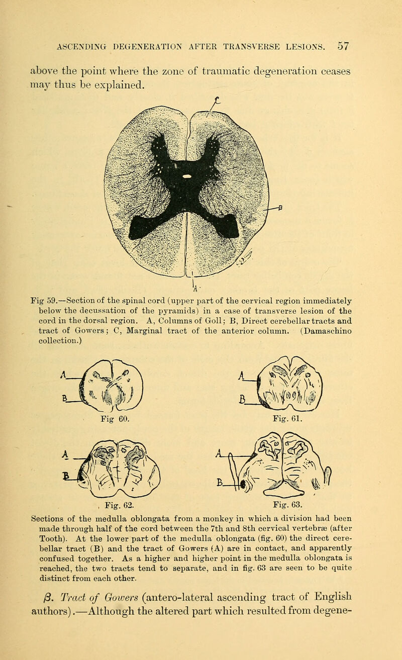 above the point where the zone of traumatic degeneration ceases may thus be explained. Fig 59.—Section of the spinal cord (upper part of the cervical region immediately below the decussation of the pyramids) in a ease of transverse lesion of the cord in the dorsal region. A, Columns of GoU; B, Direct cerebellar tracts and tract of Gowers; C, Marginal tract of the anterior column. (Damaschino collection.) Fig 60. , Fig. 62. Sections of the medulla oblongata from a monkey in which a division had been made through half of the cord between the 7th and 8th cervical vertebrae (after Tooth). At the lower part of the medulla oblongata (fig. 60) the direct cere- bellar tract (B) and the tract of Gowers (A) are in contact, and apparently confused together. As a higher and higher point in the medulla oblongata is reached, the two tracts tend to separate, and in fig. 63 are seen to be quite distinct from each other. /3. Trad of Gowers (antero-lateral ascending tract of English authors).—Although the altered part which resulted from degene-