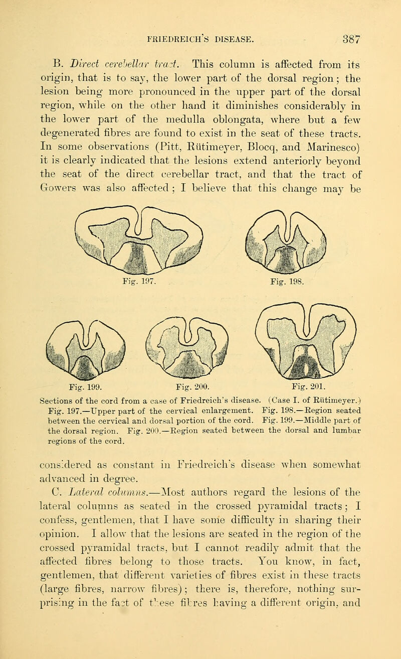 B. Direct cerehellar trad. This column is affected from its origin, that is to say, the lower part of the dorsal region; the lesion being more pronounced in the upper part of the dorsal region, while on the other hand it diminishes considerably in the lower part of the medulla oblongata, where but a few degenerated fibres are found to exist in the seat of these tracts. In some observations (Pitt, Kiitimeyer, Blocq, and Marinesco) it is clearly indicated that the lesions extend anteriorly beyond the seat of the direct cerebellar tract, and that the tract of Gowers was also affected ; I believe that this change maj^ be Fig. 197. Fig. 198. Fig. 199. Fig. 200. Sections of the cord from a case of Friedreich's disease. (Case I. of Elitimeyer.) Fig. 197.—Upper part of the cerTical enlargement. Fig. 198.—Region seated between the cervical and dorsal portion of the cord. Fig. 199.—Middle part of the dorsal region. Fig. 200.—Region seated between the dorsal and lumbar regions of the cord. cons-dered as constant in Friedreich's disease when somewhat advanced in degree. C. Lateral columns.—Most authors regard the lesions of the lateral columns as seated in the crossed pyramidal tracts; I confess, gentlemen, that I have some difficulty in sharing their opinion. I allow that the lesions are seated in the region of the crossed pyramidal tracts, but I cannot readily admit that the affected fibres belong to those tracts. You know, in fact, gentlemen, that different varieties of fibres exist in these tracts (large fibres, narrow fibres); there is, therefore, nothing sur- prising in the fa^t of t^/.ese fil:res having a different origin, and