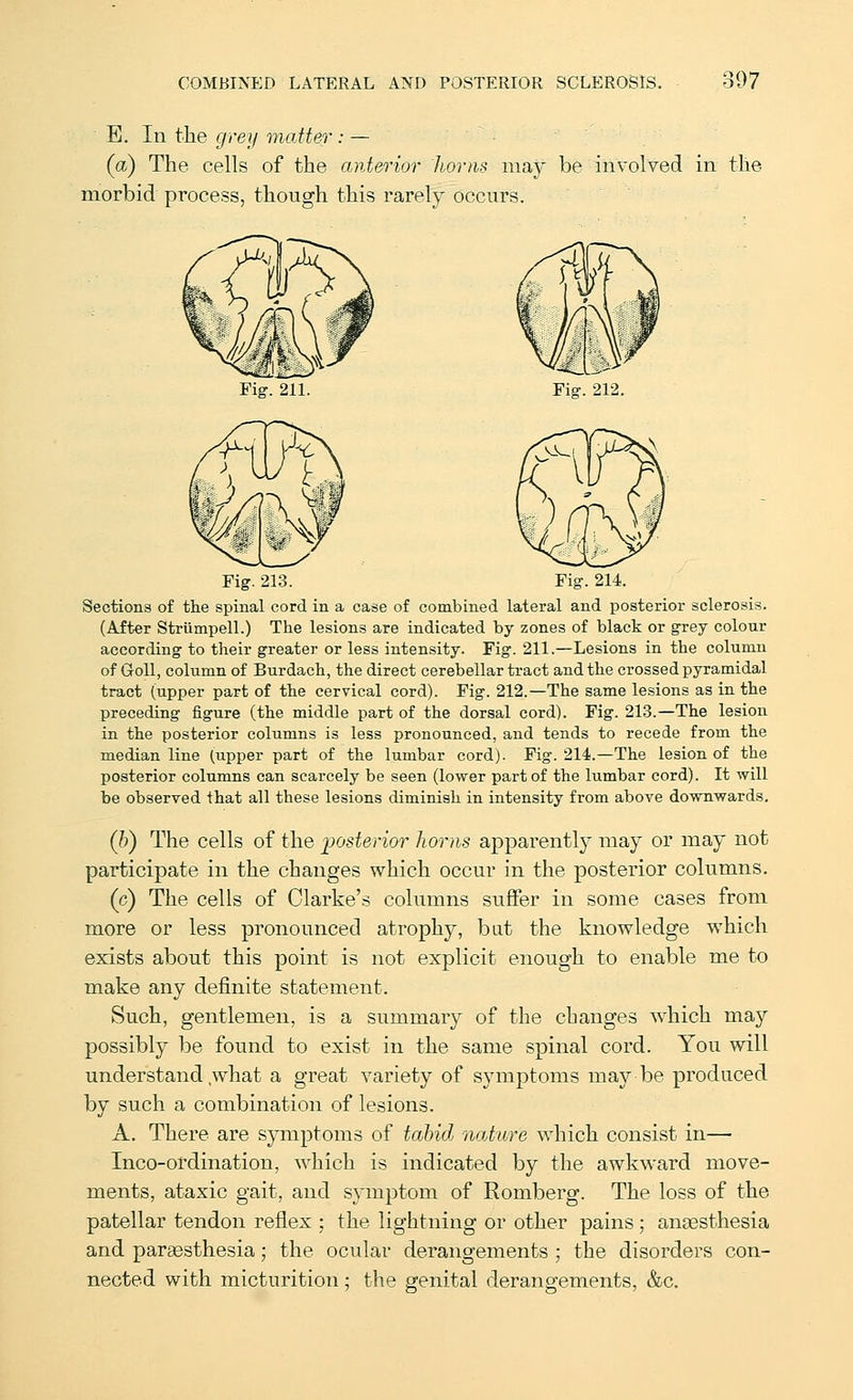 E. In the grey matter: — (a) The cells of the anterior horns may be involved in the morbid process, though this rarely occurs. Fig. 212. Fig. 213. Fig-. 214. Sections of the spinal cord in a case of combined lateral and posterior sclerosis. (After StriimpelL) The lesions are indicated by zones of black or grey colour according to their greater or less intensity. Fig. 211.—Lesions in the column of GoU, column of Burdach, the direct cerebellar tract and the crossed pyramidal tract (upper part of the cervical cord). Fig. 212.—The same lesions as in the preceding figure (the middle part of the dorsal cord). Fig. 213.—The lesion in the posterior columns is less pronounced, and tends to recede from the median line (upper part of the lumbar cord). Fig. 214.—The lesion of the posterior columns can scarcely be seen (lower part of the lumbar cord). It will be observed that all these lesions diminish in intensity from above downwards, (6) The cells of the posterior horns apparentl}^ may or may not participate in the changes which occur in the posterior columns. (c) The cells of Clarke's columns suffer in some cases from more or less pronounced atrophy, but the knowledge which exists about this point is not explicit enough to enable me to make any definite statement. Such, gentlemen, is a summary of the changes wdiich may possibly be found to exist in the same spinal cord. You will understand what a great variety of symptoms may be produced by such a combination of lesions. A. There are symptoms of tabid nature which consist in— Inco-ordination, which is indicated by the awkward move- ments, ataxic gait, and symptom of Romberg. The loss of the patellar tendon reflex ; the lightning or other pains; anaesthesia and paraesthesia; the ocular derangements ; the disorders con- nected with micturition; the genital derangements, &c.