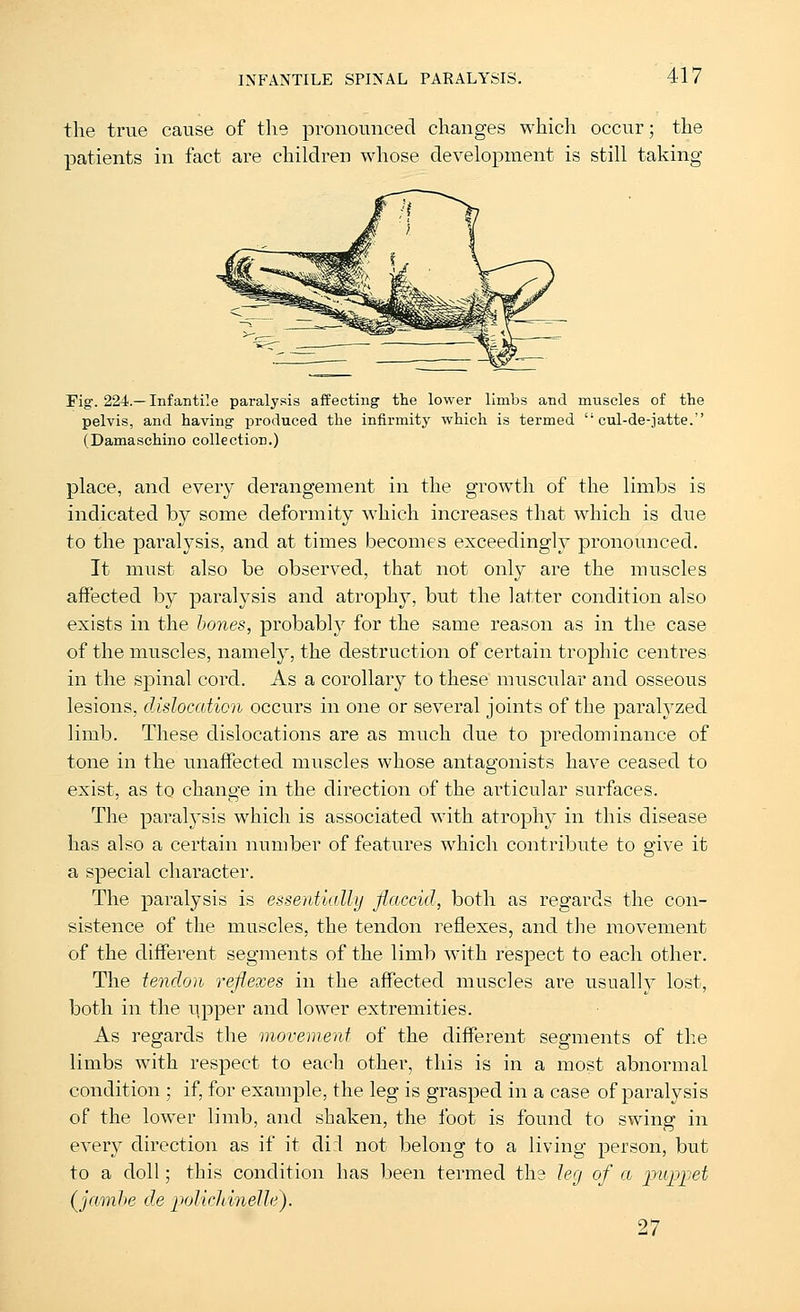 the true cause of the pronounced changes which occur; the patients in fact are children whose development is still taking- Fig. 224.—Infantile paralysis affecting the lower limbs and muscles of the pelvis, and having produced the infirmity which is termed  cul-de-jatte. (Damaschino collection.) place, and every derangement in the growth of the limbs is indicated by some deformity which increases that which is due to the pai'alysis, and at times becomes exceedingly pronounced. It must also be observed, that not only are the muscles affected by paralysis and atrophy, but the latter condition also exists in the hones, probably for the same reason as in the case of the muscles, namely, the destruction of certain trophic centres in the spinal cord. As a corollary to these muscular and osseous lesions, dislocation occurs in one or several joints of the paralyzed limb. These dislocations are as much due to predominance of tone in the unaffected muscles whose antagonists have ceased to exist, as to change in the direction of the articular surfaces. The paralysis which is associated with atrophy in this disease has also a certain number of features which contribute to give it a special character. The paralysis is essentially flaccid, both as regards the con- sistence of tlie muscles, the tendon reflexes, and tlie movement of the different segments of the limb with respect to each other. The tendon reflexes in the affected muscles are usualh lost, both in the upper and lower extremities. As regards the movement of the different segments of the limbs with respect to each other, this is in a most abnormal condition; if, for example, the leg is grasped in a case of paralysis of the lower limb, and shaken, the foot is found to swing in every direction as if it di:l not belong to a living person, but to a doll; this condition has been termed ths leg of a j^'^^F^'^ (ja.mhe de polichinelle). 27