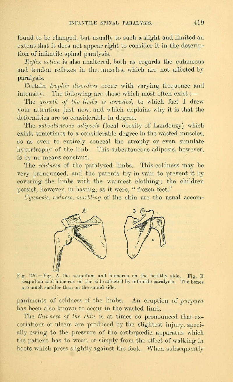 found to be changed, but usually to such a slight and limited an extent that it does not appear right to consider it in the descrip- tion of infantile spinal paralysis. Reflex action is also unaltered, both as regards the cutaneous and tendon reflexes in the muscles, which are not affected hj paralysis. Certain tropJdc disorders occur with varying frequence and intensit}^. The following are those which most often exist:— The growth of the limbs is arrested, to w^hich fact I drew your attention just now, and which explains why it is that the deformities are so considerable in degree. The suhcutaneous adiposis (local obesity of Landouzy) which exists sometimes to a considerable degree in the wasted muscles, so as even to entirely conceal the atrophy or even simulate hypertrophy of the limb. This subcutaneous adiposis, however, is by no means constant. The coldness of the paralyzed limbs. This coldness may be very pronounced, and the parents try in vain to prevent it by covering the limbs with the warmest clothing; the children persist, however, in having, as it were,  frozen feet. Cyanosis, redness, marbling of the skin are the usual accom- Pig. 226.—Fig. A the scaptilum and humerus on the healthy side. Fig. B scapulum and humerus on the side affected by infantile paralysis. The bones are much smaller than on the sound side. paniments of coldness of the limbs. An eruption of i^urjmra has been also known to occur in the wasted limb. The thinness of the sMn is at times so pronounced that ex- coriations or ulcers are produced by the slightest injury, speci- all}^ owing to the pressure of the orthopaedic apparatus which the patient has to wear, or simply from the effect of walking in boots which press slightly against the foot. When subsequently