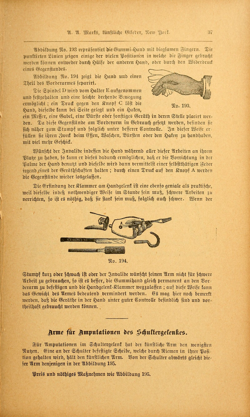 310. 193. ^bbUbung 5lo. 193 repräfcntiri i)t€®mnnii=^anb mit biegfamcn Ringern. 2)ie punftivten Linien 3eigen einige bcr Dielen ^^3ofitioncn in tüelc^c bic Ringer gebracht merbcn tonnen entlueber burc^ ^ülfe ber anbeten ^lanb, oöcr burc^ bett ilBibcrbrucf cineä @egen[tanbc§. 5lbbtlbiing 9to. 194 ^eigt bic §anb unb einen 3;{)eil be§ SSovberarmeS fe^jarirt. ®ic ©ijinbcl D n)irb öom §altcr E aufgenommen unb feflgcijültcn unb eine lei(I}te bre^enbc iBciDcgung erniöglic()t ; ein ®rudf gegen ben Änopf C I5[t bic §anb, biejelbe fann bei ©eite gelegt unb ein §alEen, ein 5!)tef}cr, eine (Säbel, eine Surfte ober fonftigeä ©erSt!^ in beren ©teile placirt wer» Jen. S)a biefe (Segenftönbe am Sßorbetarm in @ebrau(i^ gefegt toerben, befinben fic fiä) naiver sum ©tum|)f unb folgli(!) unter befferer SonttoEe. ^n biefer Söeife er: füllen fie il)ren Swed beim @f|en, SBafd^en, dürften ober ben §a!en 3U :^anb(;oben, mit üiel mel^r ©efd^id. 2[Bünf(!^t ber Snöalibe inbeffen bie §anb iüfif)renb aöer biefer ?lr6eiten an il)rem 1ßlat3e 3U ^aben, fo !onn er biefe§ baburcE) ermöglicfien, bafe er bie S3orrid^tung in ber ■s^alme ber §anb benutjt unb biefelbe wirb bann öermittelft einer felbfttptigen tyeber irgenb eine§ ber ®erätl)f(^aften lialten ; bur(i^ einen Srudauf ben ^no|)f A toerben bie ©egenftänbe loieber loSgelaffen. Die ©rfinbung ber ßlammer am §onbgelenI ift eine ebenf o geniale at§ :praftifd)e, raeil biefelbe inbcfe not^toenbiger SBeife im ©tanbe fein mu^, fc^aere ?lrbeiten ^u öerrii^ten, fo ift e§ nöt^iig, ba§ fie ftar! fein mufe, foIgli(^ auä) fd^wer. Sßenn ber ^0. 194. <5tum:pf fürs ober fi^toac^ ift ober ber ^noalibe loünfdEit feinen ?lrm nid)t für fdiiDere ^Arbeit ju gebrou(3^en, fo ift e§ beffer, bie @ummi|anb gleich permanent an ben 35or= berarm gu befeftigen unb bie Jpanbgelent^KIammer ttegäutaffen ; auf biefe Söeife tonn ba§ ©etnid^t be§ ^Ärme§ bebeutenb berminbert loerben. @§ mag ^ier noc^ bemertt roerben, ba^ bie ©erät^e in ber ^an'ö unter guter ©ontrotte befinbli(^ finb unb oor=^ t^ieill^aft gebraucht »oerben tonnen. Jlrme für ^mpufattonen be$ ^^nttexQeknke^. fvür ^•am))utotionen im Sc^ultergelen! :^at bet fünftlid^e ?(rm ben loenigften 9iul]ett. @ine an ber ©d^ulter befeftigte ©d^eibe, tt)elcE)e huxä) üiiemen in if)rer ^ofi= tion get)alten wirb, f)ält ben fünftlidlien ^rm. SSon ber @cl)ulter abtt)ärt§ gleist bie-^ fer %vm benfenigen in ber ^bbilbung 195. 5ßrei§ unb nötl^tgeS Mafenel^men wie ^bbtlbung 195.