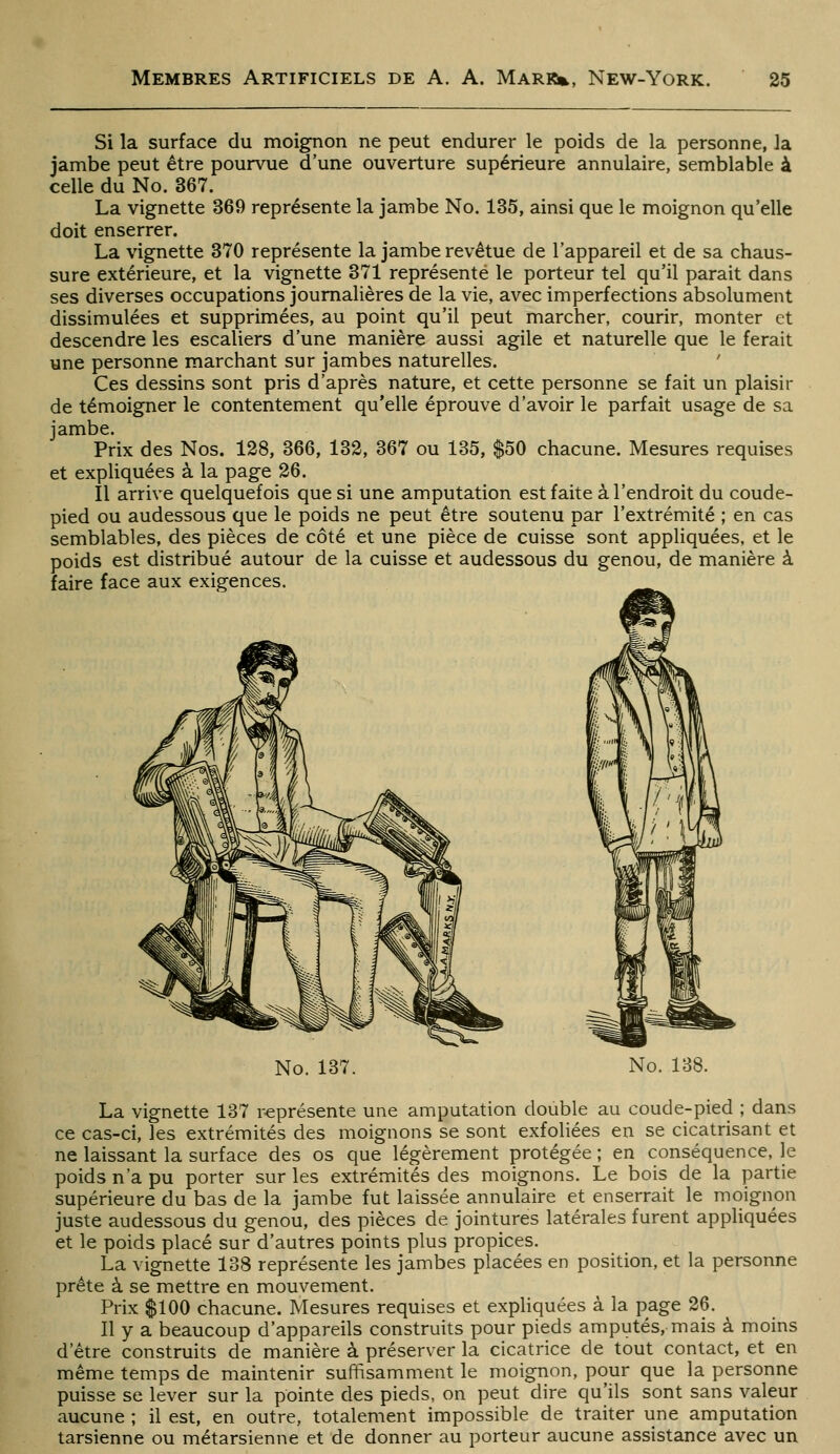 Si la surface du moignon ne peut endurer le poids de la personne, la jambe peut être pourvue d'une ouverture supérieure annulaire, semblable à celle du No. 367. La vignette 369 représente la jambe No. 135, ainsi que le moignon qu'elle doit enserrer. La vignette 370 représente la jambe revêtue de l'appareil et de sa chaus- sure extérieure, et la vignette 371 représente le porteur tel qu'il parait dans ses diverses occupations journalières de la vie, avec imperfections absolument dissimulées et supprimées, au point qu'il peut marcher, courir, monter et descendre les escaliers d'une manière aussi agile et naturelle que le ferait une personne marchant sur jambes naturelles. ' Ces dessins sont pris d'après nature, et cette personne se fait un plaisir de témoigner le contentement qu'elle éprouve d'avoir le parfait usage de sa jambe. Prix des Nos. 128, 366, 132, 367 ou 135, $50 chacune. Mesures requises et expliquées à la page 26. Il arrive quelquefois que si une amputation est faite à l'endroit du coude- pied ou audessous que le poids ne peut être soutenu par l'extrémité ; en cas semblables, des pièces de côté et une pièce de cuisse sont appliquées, et le poids est distribué autour de la cuisse et audessous du genou, de manière à faire face aux exigences. No. 137. No. 138. La vignette 137 représente une amputation double au coude-pied ; dans ce cas-ci, les extrémités des moignons se sont exfoliées en se cicatrisant et ne laissant la surface des os que légèrement protégée ; en conséquence, le poids n'a pu porter sur les extrémités des moignons. Le bois de la partie supérieure du bas de la jambe fut laissée annulaire et enserrait le moignon juste audessous du genou, des pièces de jointures latérales furent appliquées et le poids placé sur d'autres points plus propices. La vignette 138 représente les jambes placées en position, et la personne prête à se mettre en mouvement. Prix $100 chacune. Mesures requises et expliquées à la page 26. Il y a beaucoup d'appareils construits pour pieds amputés, mais à moins d'être construits de manière à préserver la cicatrice de tout contact, et en même temps de maintenir suffisamment le moignon, pour que la personne puisse se lever sur la pointe des pieds, on peut dire qu'ils sont sans valeur aucune ; il est, en outre, totalement impossible de traiter une amputation tarsienne ou métarsienne et de donner au porteur aucune assistance avec un