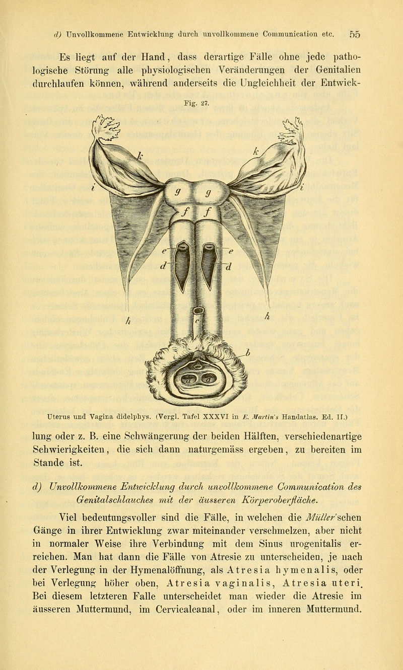 Es liegt auf der Hand, dass derartige Fälle ohne jede patho- logische Störung alle physiologischen Veränderungen der Genitalien durchlaufen können, während anderseits die Ungleichheit der Entwick- Fig. 27. Uterus und Vagina didelphys. (Vergl. Tafel XXXVI in E. Iflartin's Handatlas. Ed. IT.) lung oder z. B. eine Schwängerung der beiden Hälften, verschiedenartige Schwierigkeiten, die sich dann naturgemäss ergeben, zu bereiten im Stande ist. d) Unvollkommene EntwicTclung durch unvollkommene Communication des Qenitalschlauches mit der äusseren KörperoherßäcJie. Viel bedeutungsvoller sind die Fälle, in welchen die Jf^V/^r sehen Gänge in ihrer Entwicklung zwar miteinander verschmelzen, aber nicht in normaler Weise ihre Verbindung mit dem Sinus urogenitalis er- reichen. Man hat dann die Fälle von Atresie zu unterscheiden, je nach der Verlegung in der Hymenalöffnung, als A t r e s i a h y m e n a 1 i s, oder bei Verlegung höher oben, Atresia vaginalis, Atresia uteri. Bei diesem letzteren Falle unterscheidet man wieder die Atresie im äusseren Muttermund, im Cervicalcanal, oder im inneren Muttermund.