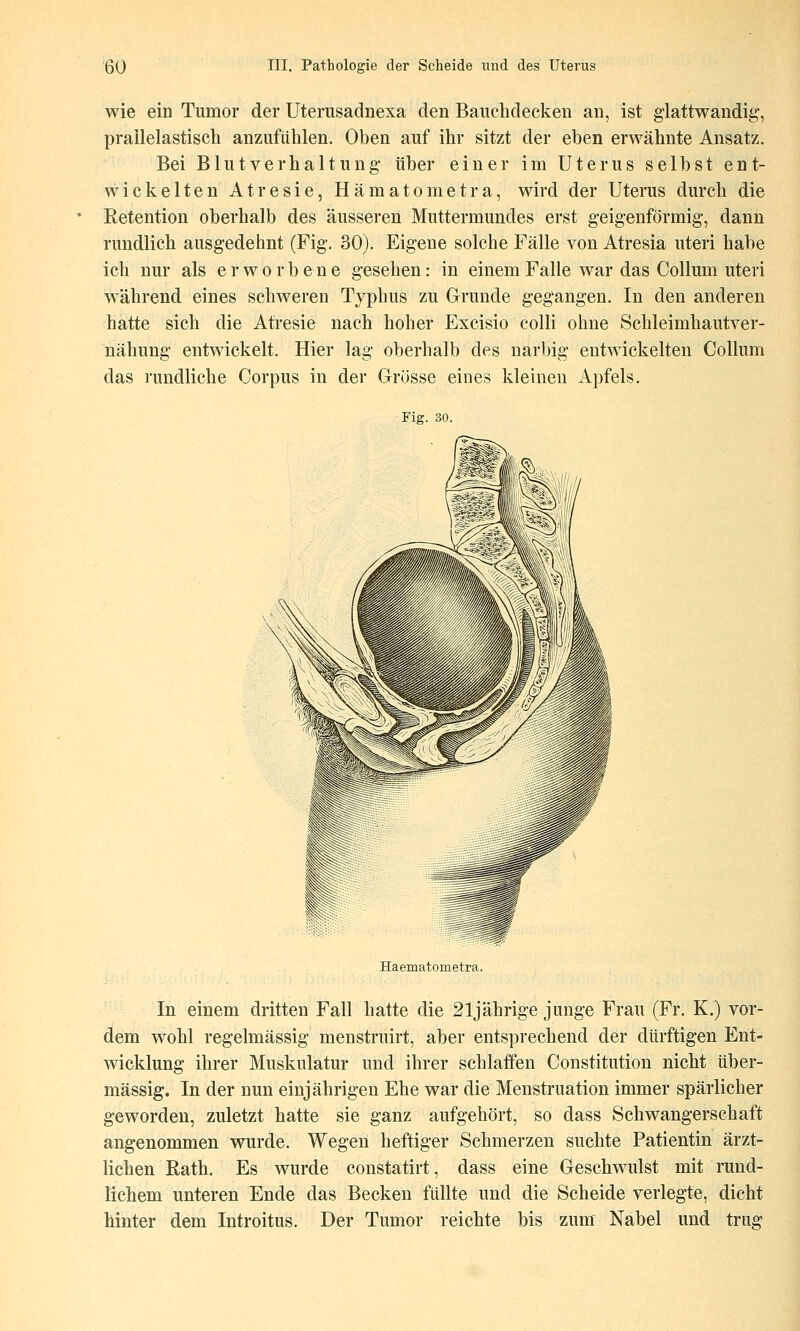 wie ein Tumor der Uterusadnexa den Baiichdeckeu an, ist glattwandig, prailelastisch anzufühlen. Oben auf ihr sitzt der eben erwähnte Ansatz. Bei B1 utVerha 11ung- über einer im Uterus selbst ent- wickelten Atresie, Hämatom et ra, wird der Uterus durch die Retention oberhalb des äusseren Muttermundes erst geigenförmig-, dann rundlich ausgedehnt (Fig. 30). Eigene solche Fälle von Atresia uteri habe ich nur als erworbene gesehen: in einem Falle war das Collum uteri während eines schweren Typhus zu Grunde gegangen. In den anderen hatte sich die Atresie nach hoher Excisio colli ohne Schleimhautver- nähung entwickelt. Hier lag oberhalb des narbig entwickelten Collum das rundliche Corpus in der Grösse eines kleinen Apfels. Fig. 30. Haematometra. In einem dritten Fall hatte die 21jährige junge Frau (Fr. K.) vor- dem wohl regelmässig menstruirt, aber entsprechend der dürftigen Ent- wicklung ihrer Muskulatur und ihrer schlaifen Constitution nicht über- mässig. In der nun einjährigen Ehe war die Menstruation immer spärlicher geworden, zuletzt hatte sie ganz aufgehört, so dass Schwangerschaft angenommen wurde. Wegen heftiger Schmerzen suchte Patientin ärzt- lichen ßath. Es wurde constatirt, dass eine Geschwulst mit rund- lichem unteren Ende das Becken füllte und die Scheide verlegte, dicht hinter dem Introitus. Der Tumor reichte bis zum Nabel und trug