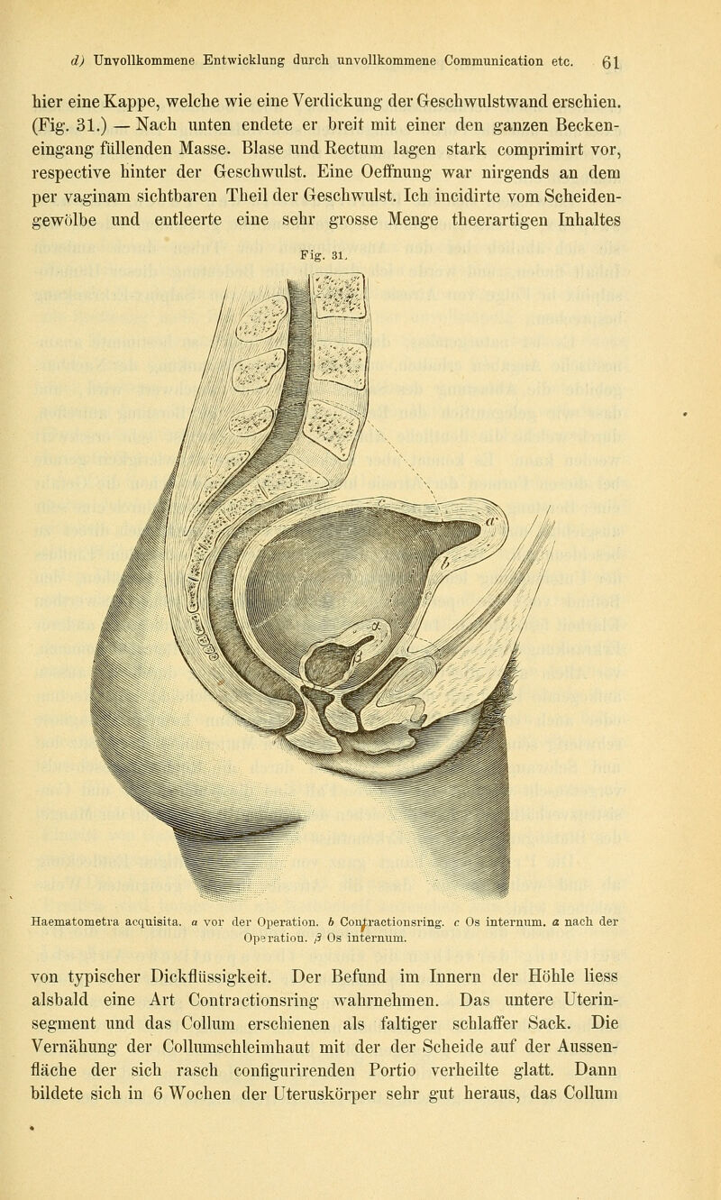 hier eine Kappe, welche wie eine Verdickung der Geschwulstwand erschien. (Fig. 31.) — Nach unten endete er breit mit einer den ganzen Becken- eingang füllenden Masse. Blase und Rectum lagen stark comprimirt vor, respective hinter der Geschwulst. Eine Oeffnung war nirgends an dem per vaginam sichtbaren Theil der Geschwulst. Ich incidirte vom Scheiden- gewölbe und entleerte eine sehr grosse Menge theerartigen Inhaltes Fig. 31. Haematometra acquisita. a vor der Operation, b Conlractionsring. c Os internum, a nach der Operation, ß Os internum. von typischer Dickflüssigkeit. Der Befund im Innern der Höhle Hess alsbald eine Art Contra ctionsring wahrnehmen. Das untere Uterin- segment und das Collum erschienen als faltiger schlaffer Sack. Die Vernähung der Collumschleimhaut mit der der Scheide auf der Aussen- fläche der sich rasch configurirenden Portio verheilte glatt. Dann