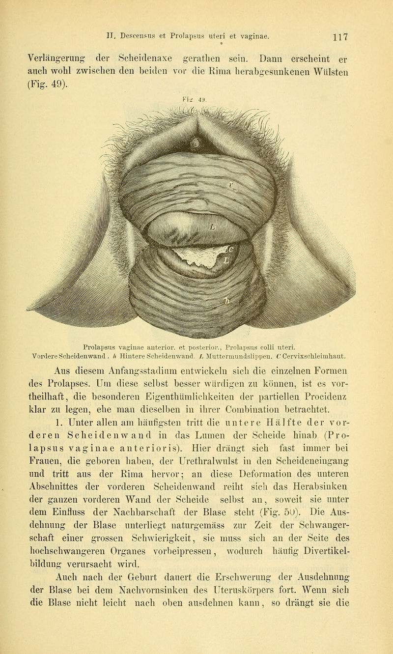 Verlängerung der Seheidenaxe gerathen sein. Dann erscheint er auch wohl zwischen den beiden vor die Rima herabgesunkenen Wülsten (Fig. 49). Prolapsus vaginae anterior, et posterioi-., Prolapsus colli uteri. Vordere Scheidenwand . h Hintere Sclieidenwand. /, Mutteraiundslippeu. C CervixscMeimliaut. Aus diesem Anfangsstadium entwickeln sich die einzelnen Formen des Prolapses. Um diese selbst besser würdigen zu können, ist es vor- theilhaft, die besonderen Eigenthümlichkeiten der partiellen Procidenz klar zu legen, ehe man dieselben in ihrer Combination betrachtet. 1. Unter allen am häufigsten tritt die untere Hälfte der v o r- deren Scheidenwand in das Lumen der Scheide hinab (P r o- lapsus vaginae anterioris). Hier drängt sich fast immer bei Frauen, die geboren haben, der Urethralwulst in den Scheideneingang und tritt aus der Rima hervor; an diese Deformation des unteren Abschnittes der vorderen Scheidenwand reiht sich das Herabsinken der ganzen vorderen Wand der Scheide selbst an, soweit sie unter dem Einfluss der Nachbarschaft der Blase steht (Fig. 5ü). Die Aus- dehnung der Blase unterliegt naturgemäss zur Zeit der Schwanger- schaft einer grossen Schwierigkeit, sie muss sich an der Seite des hochschwangeren Organes vorbeipressen, wodurch häufig Divertikel- bildung verursacht wird. Auch nach der Geburt dauert die Erschwerung der Ausdehnung der Blase bei dem Nachvornsinken des Uteruskörpers fort. Wenn sich die Blase nicht leicht nach oben ausdehnen kann, so drängt sie die