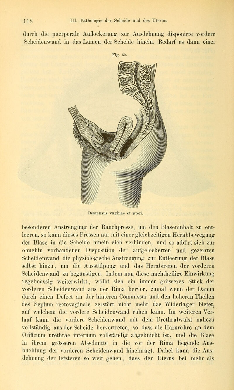 durch die puerperale Auflockerung zur Ausdehnung- disponirte vordere Scheidenwand in das Lumen der Scheide hinein. Bedarf es dann einer Fig. 50. Desceusiis vagiuae et uteri. besonderen Anstrengung der Bauchpresse, um den Blaseninhalt zu ent- leeren, so kann dieses Pressen nur mit einer gleichzeitigen Herabhewegung der Blase in die Scheide hinein sich verbinden, und so addirt sich zur ohnehin vorhandenen Disposition dei- aufgelockerten und gezerrten Scheidenwand die physiologische Anstrengung zur Entleerung der Blase selbst hinzu, um die Ausstülpung und das Herabtreten der vorderen Scheidenwand zu begünstigen. Indem nun diese nachtheilige Einwirkung regelmässig weiterwirkt, wölbt sich ein immer grösseres Stück der vorderen Scheidenwand aus der Rima hervor, zumal wenn der Damm durch einen Defect an der hinteren Commissur und den höheren Theilen des Septum rectovaginale zerstört nicht mehr das Widerlager bietet, auf welchem die vordere Scheidenwand ruhen kann. Im weiteren Ver- lauf kann die vordere Scheidenwand mit dem Urethralwulst nahezu vollständig aus der Scheide hervortreten, so dass die Harnröhre an dem Orificium urethrae internum vollständig abgeknickt ist, und die Blase in ihrem grösseren Abschnitte in die vor der Rima liegende Aus- buchtung der vorderen Scheidenwand hineinragt. Dabei kann die Aus- dehnung der letzteren so weit gehen, dass der Uterus bei mehr als