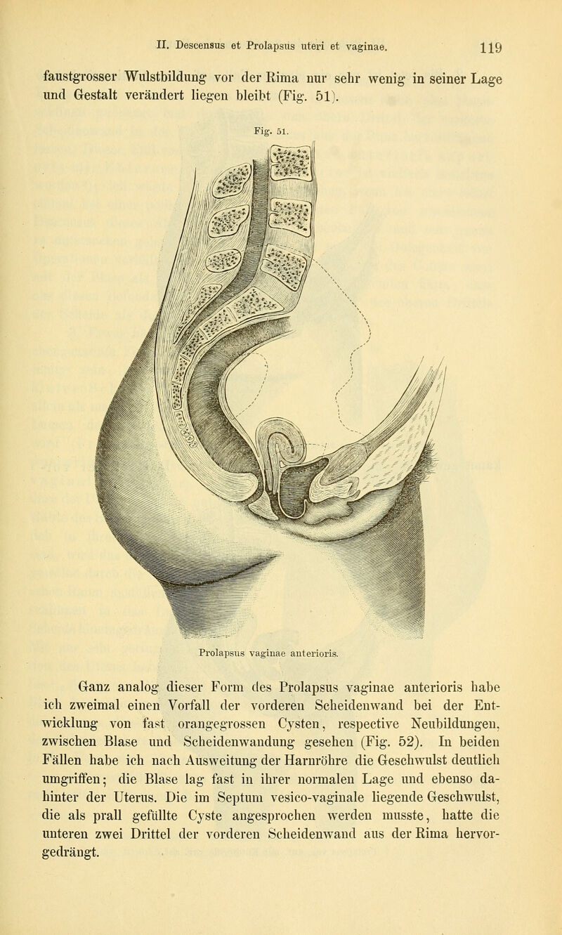 faustgTOsser Wulstbildung vor der Rima nur sehr wenig in seiner Lage und Gestalt verändert liegen bleibt (Fig. 51). Fig. 51. Prolapsus vaginae anterioris. Ganz analog dieser Form des Prolapsus vaginae anterioris habe ich zweimal einen Vorfall der vorderen Scheidenwand bei der Ent- wicklung von fast orangegrossen Cysten, respective Neubildungen, zwischen Blase und Scheidenwandung gesehen (Fig. 52), In beiden Fällen habe ich nach Ausweitung der Harnröhre die Geschwulst deutlich umgriffen; die Blase lag fast in ihrer normalen Lage und ebenso da- hinter der Uterus. Die im Septum vesico-vaginale liegende Geschwulst, die als prall gefüllte Cyste angesprochen werden musste, hatte die unteren zwei Drittel der vorderen Scheidenwand aus der Rima hervor- gedrängt.