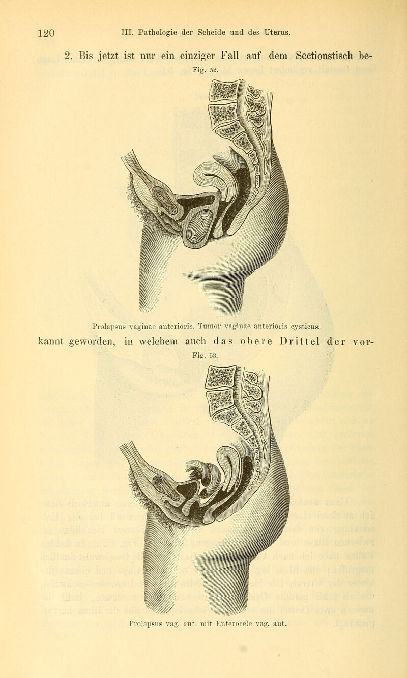 2. Bis jetzt ist nur ein einziger Fall auf dem Sectionstisch be- Fig. 52. Prolapsus vagiuae anterioris. Tumor vaginae auterioris cysticus. kannt geworden, in welchem auch das obere Drittel der vor- Fie-. 53 Prolapsus vag. ant. mit Enterocele vag. ant.