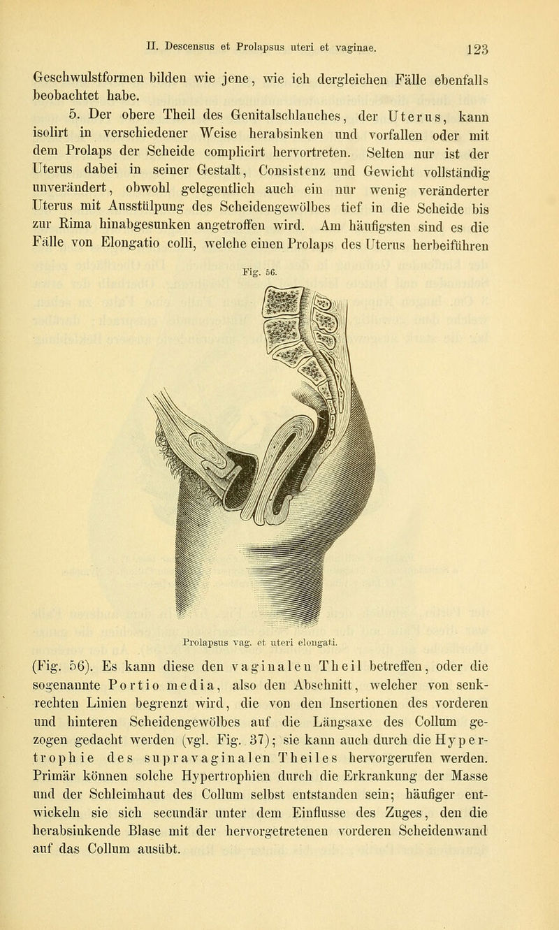 Geschwulstformen bilden wie jene, wie ich dergleichen Fälle ebenfalls beobachtet habe. 5. Der obere Theil des Genitalschlauches, der Uterus, kann isolirt in verschiedener Weise herabsinken und vorfallen oder mit dem Prolaps der Scheide complicirt hervortreten. Selten nur ist der Uterus dabei in seiner Gestalt, Consistenz und Gewicht vollständig unverändert, obwohl gelegentlich auch ein nur wenig veränderter Uterus mit Ausstülpung des Scheidengewölbes tief in die Scheide bis zur ßima hinabgesunken angetroffen wird. Am häufigsten sind es die Fälle von Elongatio colli, welche einen Prolaps des Uterus herbeiführen Fig. 56. Prolapsus vag-, et uteri elougati. (Fig. 56). Es kann diese den vaginalen Theil betreffen, oder die sogenannte Portio media, also den Abschnitt, welcher von senk- rechten Linien begrenzt wird, die von den Insertionen des vorderen und hinteren Scheidengewölbes auf die Längsaxe des Collum ge- zogen gedacht werden (vgl. Fig. 37); sie kann auch durch die Hyper- trophie des supravaginalen Theiles hervorgerufen werden. Primär können solche Hypertrophien durch die Erkrankung der Masse und der Schleimhaut des Collum selbst entstanden sein; häufiger ent- wickeln sie sich secundär unter dem Einflüsse des Zuges, den die herabsinkende Blase mit der hervorgetretenen vorderen Scheidenwand auf das Collum ausübt.
