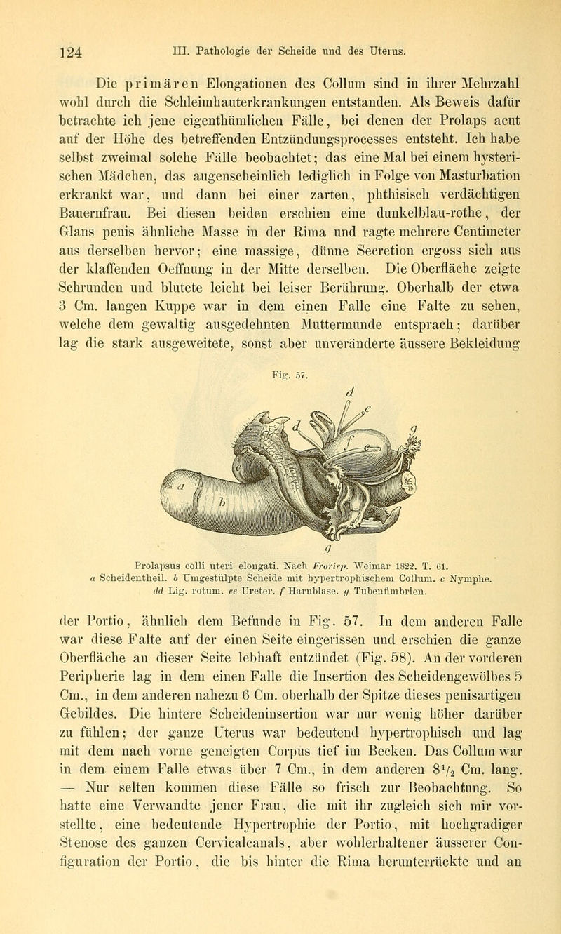 Die primären Elongationen des Collum sind in ihrer Mehrzahl wohl durch die Schleimhauterkrankungen entstanden. Als Beweis dafür betrachte ich jene eigenthümlichen Fälle, bei denen der Prolaps acut auf der Höhe des betreffenden Entzündungsprocesses entsteht. Ich habe selbst zweimal solche Fälle beobachtet; das eine Mal bei einem hysteri- schen Mädchen, das augenscheinlich lediglich in Folge von Masturbation erkrankt war, und dann bei einer zarten, phthisisch verdächtigen Bauernfrau. Bei diesen beiden erschien eine dunkelblau-rothe, der Glans penis ähnliche Masse in der Rima und ragte mehrere Centimeter aus derselben hervor; eine massige, dünne Secretion ergoss sich aus der klaffenden Oeffnung in der Mitte derselben. Die Oberfläche zeigte Schrunden und blutete leicht bei leiser Berührung. Oberhalb der etwa 3 Cm. langen Kuppe war in dem einen Falle eine Falte zu sehen, welche dem gewaltig ausgedehnten Muttermunde entsprach; darüber lag die stark ausgeweitete, sonst aber unveränderte äussere Bekleidung Fig. 57. Prolapsus colli uteri elongati. Nach Fruriep. Weimar 1822. T. 61. a Scheideutlieil. b Umgestülpte Scheide mit hypertrophischem Collum, c Nymphe. dd Lig. rotum. ve Ureter, f Harnblase, n Tuhenflmbrien. der Portio, ähnlich dem Befunde in Fig. 57. In dem anderen Falle war diese Falte auf der einen Seite eingerissen und erschien die ganze Oberfläche an dieser Seite lebhaft entzündet (Fig. 58). An der vorderen Peripherie lag in dem einen Falle die Insertion des Scheidengewölbes 5 Cm., in dem anderen nahezu 6 Cm. oberhalb der Spitze dieses penisartigen Gebildes. Die hintere Scheideninsertion war nur wenig höher darüber zu fühlen; der ganze Uterus war bedeutend hypertrophisch und lag mit dem nach vorne geneigten Corpus tief im Becken. Das Collum war in dem einem Falle etwas über 7 Cm., in dem anderen 8V2 Cm. lang. — Nur selten kommen diese Fälle so frisch zur Beobachtung. So hatte eine Verwandte jener Frau, die mit ihr zugleich sich mir vor- stellte , eine bedeutende Hypertrophie der Portio, mit hochgradiger Stenose des ganzen Cervicalcanals, aber wohlerhaltener äusserer Con- figuration der Portio, die bis hinter die Rima herunterrückte und an