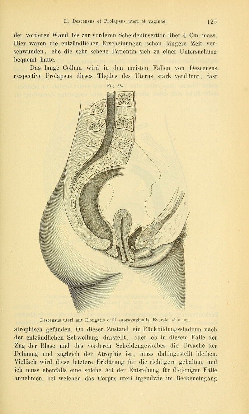 der vorderen Wand bis zur vorderen Scheideninsertion über 4 Cm. mass. Hier waren die entzündlichen Erscheinungen schon längere Zeit ver- schwunden;, ehe die sehr scheue Patientin sich zu einer Untersuchung bequemt hatte. Das lange Collum wird in den meisten Fällen von Descensus respective Prolapsus dieses Theiles des Uterus stark verdünnt, fast Fig. 58. Descensus uteri mit Elongatio colli supravaginalis. Eversio labioium. atrophisch gefunden. Ob dieser Zustand ein Rückbilduugsstadium nach der entzündlichen Schwellung darstellt, oder ob in diesem Falle der Zug der Blase und des vorderen Scheidengewölbes die Ursache der Dehnung und zugleich der Atrophie ist, muss dahingestellt bleiben. Vielfach wird diese letztere Erklärung für die richtigere gehalten, und ich muss ebenfalls eine solche Art der Entstehung für diejenigen Fälle annehmen, bei welchen das Corpus uteri irgendwie im Beckeneingang