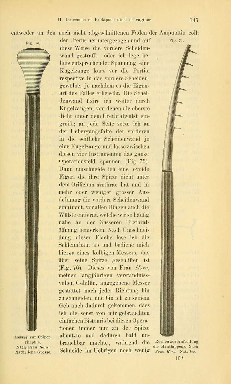 entweder an den noch nicht abgeschnittenen Fäden der Amputatio colli „. .,. der Uterus herimterffezoffen und auf Fig. 7/. diese Weise die vordere Scheiden- wand gestrafft, oder ich lege be- hufs entsprechender Spannung eine Kugelzange kurz vor die Portio, respective in das vordere Scheiden- gewölbe, je nachdem es die Eigen- art des Falles erheischt. Die Schei- denwand fixire ich weiter durch Kugelzangen, von denen die oberste dicht unter dem Urethralwulst ein- greift; an jede Seite setze ich an der Uebergangsfalte der vorderen in die seitliche Scheiden wand je eine Kugelzange und lasse zwischen diesen vier Instrumenten das ganze Operationsfeld spannen (Fig. 75). Dann umschneide ich eine ovoide Figur, die ihre Spitze dicht unter dem Orificium urethrae hat und in mehr oder weniger grosser Aus- dehnung die vordere Scheidenwand einnimmt, vor allen Dingen auch die Wülste entfernt, welche wir so häufig nahe an der äusseren ürethral- öffnung bemerken. Nach ümschnei- dung dieser Fläche löse ich die Schleimhaut ab und bediene mich hierzu eines kolbigen Messers, das über seine Spitze geschliffen ist (Fig. 76). Dieses von Frau Horn^ meiner langjährigen verständniss- vollen Gehilfin, angegebene Messer gestattet nach jeder Richtung hin zu schneiden, und bin ich zu seinem Gebrauch dadurch gekommen, dass ich die sonst von mir gebrauchten einfachen Bistouris bei diesen Opera- tionen immer nur an der Spitze abnutzte und dadurch bald un- brauchbar machte, während die Rechen zur AufroUung des Hautlappens. Nacü Schneide im Uebrigen noch wenig Frau mm. Nat. Gr. 10* Messer zur Colpor- rhaphie. Nacli Frau Hora. Natürliche Grösse.