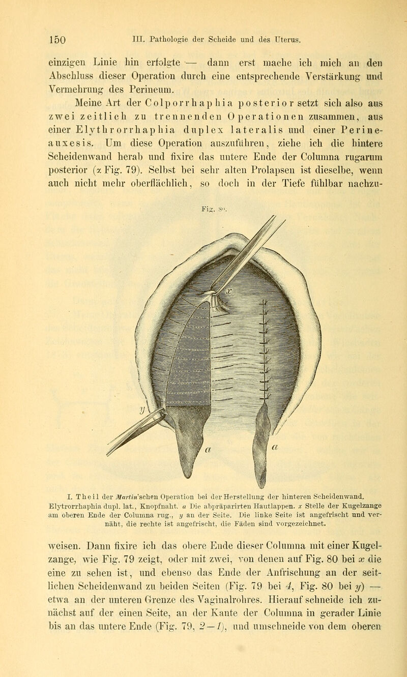 einzigen Linie hin erfolgte — dann erst mache ich mich an den Abschluss dieser Operation durch eine entsprechende Verstärkung und Vermehrung des Perineum. Meine Art der C o 1 p o r r h a p h i a posterior setzt sich also aus zwei zeitlich zu trennenden Operationen zusammen, aus einer Elythr orrhap hia duplex lateralis und einer Perine- auxesis. Um diese Operation auszuführen, ziehe ich die hintere Scheidenwand herab und fixire das untere Ende der Columna rugarum posterior (a Fig. 79). Selbst bei sehr alten Prolapsen ist dieselbe, wenn auch nicht mehr oberflächlich, so doch in der Tiefe fühlbar nachzu- I. T h e i 1 der Martin'schen Operation bei der Herstellung der hinteren Scheidenwand. Elytrorrhapliia dupl. lat., Knopfnaht. a Die abpräparirten Hautlappen, x Stelle der Kugelzange am oberen Ende der Columna rüg., y an der Seite. Die liuke Seite i.st angefrischt und ver- näht, die rechte ist angefrischt, die Fäden sind vorgezeichnet. weisen. Dann fixire ich das obere Ende dieser Columna mit einer Kugel- zangC; wie Fig. 79 zeigt, oder mit zwei, Yon denen auf Fig. 80 bei x die eine zu sehen ist, und ebenso das Ende der Anfrischung an der seit- lichen Scheidenwand zu beiden Seiten (Fig. 79 bei 4, Fig. 80 bei y) — etwa an der unteren Grenze des Vaginalrohres. Hierauf schneide ich zu- nächst auf der einen Seite, an der Kante der Columna in gerader Linie bis an das untere Ende (Fig. 79, 5—i), und umschneide von dem oberen