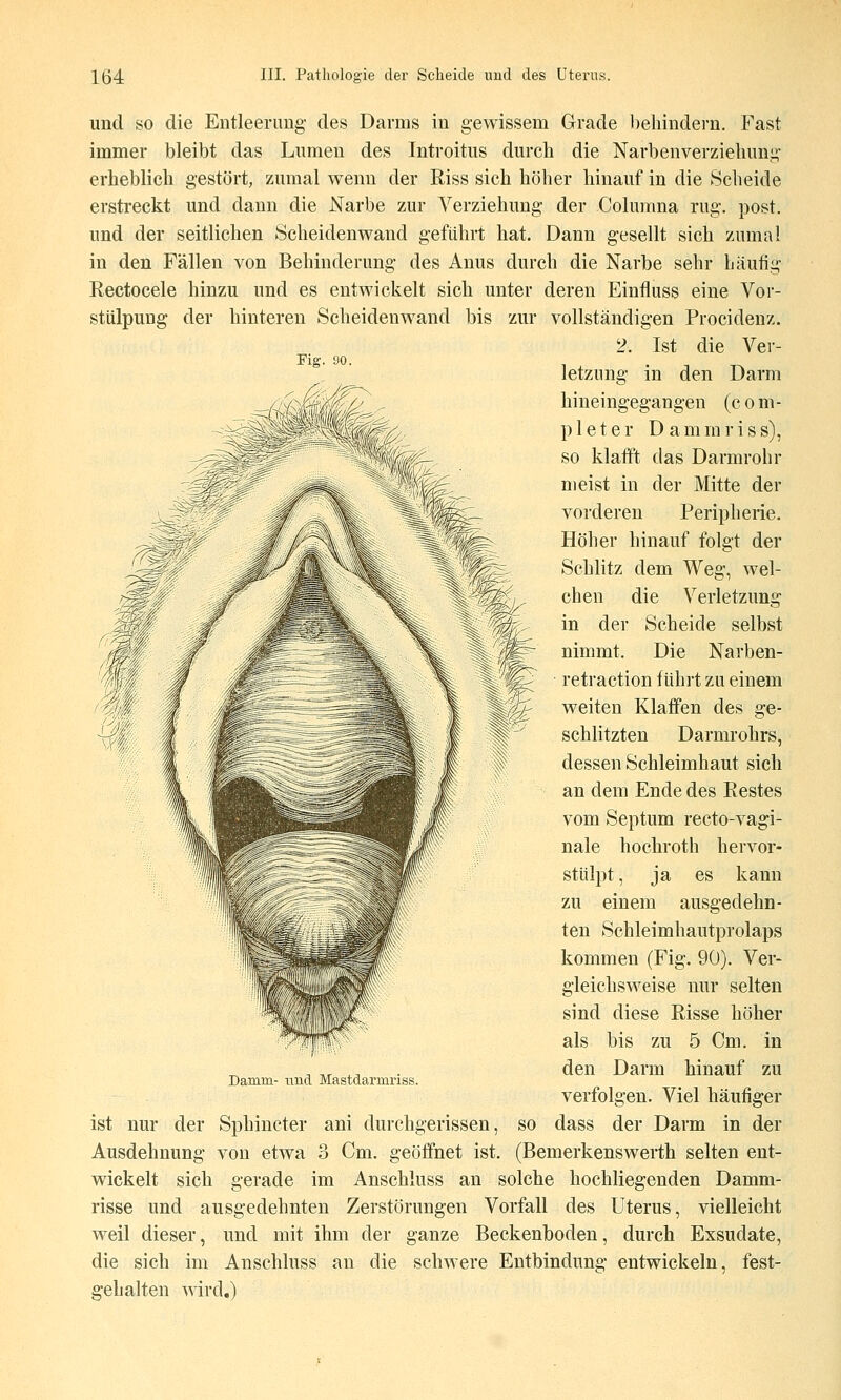 Fig. 90. und so die Entleerung des Darms in gewissem Grade behindern. Fast immer bleibt das Lumen des Introitus durch die Narbenverziehung erheblich gestört, zumal wenn der Riss sich höher hinauf in die Scheide erstreckt und dann die Narbe zur Verziehung der Columna rüg. post. und der seitlichen Scheidenwand geführt hat. Dann gesellt sich zumal in den Fällen von Behinderung des Anus durch die Narbe sehr häufig Rectocele hinzu und es entwickelt sich unter deren Einfliiss eine Vor- stülpung der hinteren Scheidenwand bis zur vollständigen Procidenz. 2. Ist die Vei-- letznng in den Darm hineingegangen (com- p 1 eter Dammriss), so klafft das Darmrohr meist in der Mitte der vorderen Peripherie. Höher hinauf folgt der Schlitz dem Weg, wel- chen die Verletzung in der Scheide selbst nimmt. Die Narben- retraction führt zu einem weiten Klaffen des ge- schlitzten Darmrohrs, dessen Schleimhaut sich an dem Ende des Restes vom Septum recto-vagi- nale hochroth hervor- stülpt , ja es kann zu einem ausgedehn- ten Schleimhautprolaps kommen (Fig. 90). Ver- gleichsweise nur selten sind diese Risse höher als bis zu 5 Cm. in den Darm hinauf zu verfolgen. Viel häufiger ist nur der Sphincter ani durchgerissen, so dass der Darm in der Ausdehnung von etwa 3 Cm, geöffnet ist. (Bemerkenswerth selten ent- wickelt sich gerade im Anschluss an solche hochliegenden Damm- risse und ausgedehnten Zerstörungen Vorfall des Uterus, vielleicht weil dieser, und mit ihm der ganze Beckenboden, durch Exsudate, die sich im Anschluss an die schwere Entbindung entwickeln, fest- gehalten wird.) Damm- iiud Mastdarmriss.