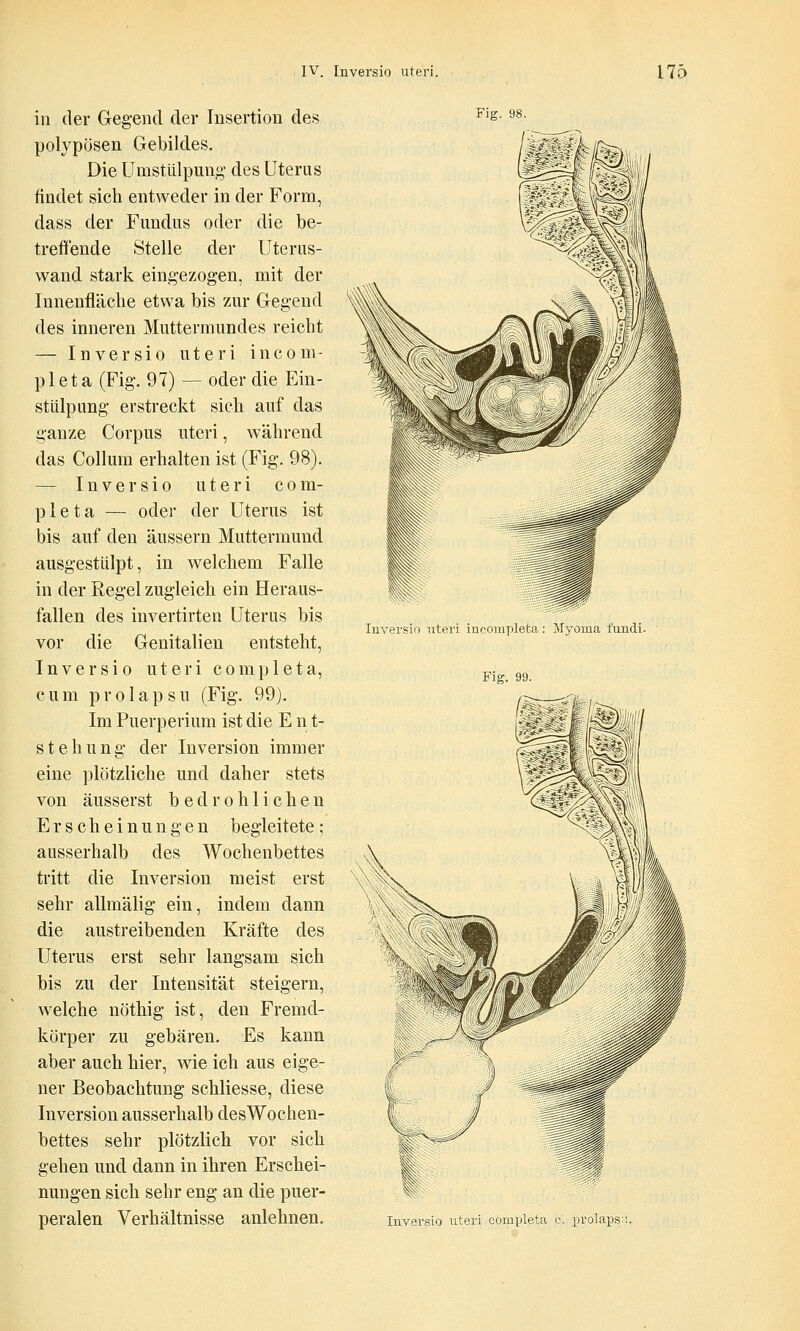 in der Gegend der Insertion des polypösen Gebildes. Die Umstülpung' des Uterus findet sich entweder in der Form, dass der Fundus oder die be- treffende Stelle der Uterus- wand stark eingezogen, mit der Innenfläche etwa bis zur Gegend des inneren Muttermundes reicht — Inversio uteri incom- pleta (Fig. 97) — oder die Ein- stülpung erstreckt sich auf das ganze Corpus uteri, während das Collum erhalten ist (Fig. 98). — Inversio uteri com- pleta — oder der Uterus ist bis auf den äussern Muttermund ausgestülpt, in welchem Falle in der Regel zugleich ein Heraus- fallen des invertirten Uterus bis vor die Genitalien entsteht, Inversio uteri completa, cum prolapsu (Fig. 99). Im Puerperium ist die E n t- stehung der Inversion immer eine plötzliche und daher stets von äusserst bedrohlichen Erscheinungen begleitete; ausserhalb des Wochenbettes tritt die Inversion meist erst sehr allmälig ein, indem dann die austreibenden Kräfte des Uterus erst sehr langsam sich bis zu der Intensität steigern, welche nöthig ist, den Fremd- körper zu gebären. Es kann aber auch hier, wie ich aus eige- ner Beobachtung schliesse, diese Inversion ausserhalb desWochen- bettes sehr plötzlich vor sich gehen und dann in ihren Erschei- nungen sich sehr eng an die puer- peralen Verhältnisse anlehnen. Fig. 98. Inversio uteri incompleta: Myoma fundi. Fig. 99. Inversio uteri completa c. prolaps-.i.