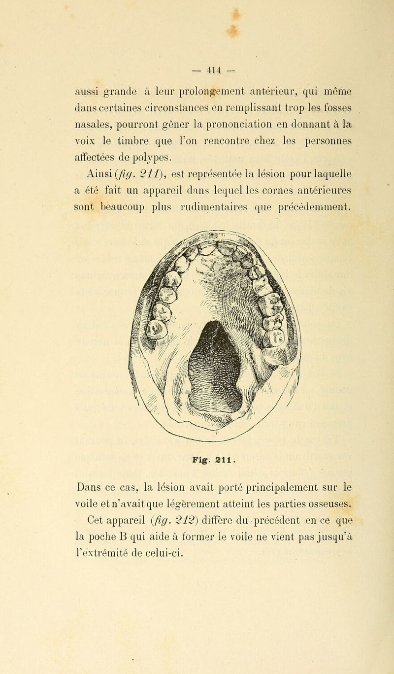 aussi grande à leur prolongement antérieur, qui même dans certaines circonstances en remplissant trop les fosses nasales, pourront gêner la prononciation en donnant à la voix le timbre que Ton rencontre chez les personnes affectées de polypes. Ainsi (fig. 211), est représentée la lésion pour laquelle a été fait un appareil dans lequel les cornes antérieures sont beaucoup plus rudimentaires que précédemment. Fig. 311 Dans ce cas, la lésion avait porté principalement sur le voile et n'avait que légèrement atteint les parties osseuses. Cet appareil {fig. 212) diffère du précédent en ce que la poche B qui aide à former le voile ne vient pas jusqu'à l'extrémité de celui-ci.