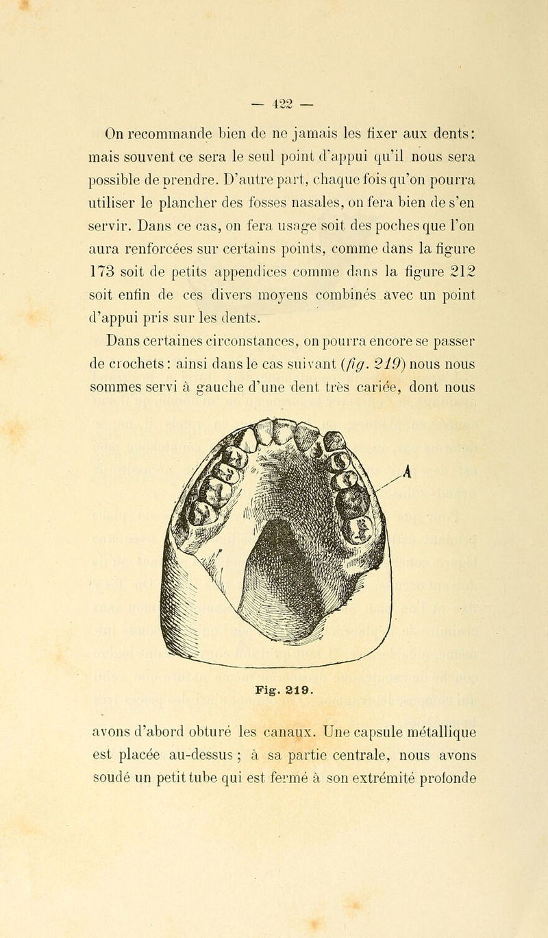 On recommande bien de ne jamais les fixer aux dents: mais souvent ce sera le seul point d'appui qu'il nous sera possible de prendre. D'autre part, chaque fois qu'on pourra utiliser le plancher des fosses nasales, on fera bien de s'en servir. Dans ce cas, on fera usage soit des poches que l'on aura renforcées sur certains points, comme dans la figure 173 soit de petits appendices comme dans la figure 212 soit enfin de ces divers moyens combinés .avec un point d'appui pris sur les dents. Dans certaines circonstances, on pourra encore se passer de crochets : ainsi dans le cas suivant (fig. 219) nous nous sommes servi à gauche d'une dent très cariée, dont nous Fig. 219. avons d'abord obturé les canaux. Une capsule métallique est placée au-dessus ; à sa partie centrale, nous avons soudé un petit tube qui est fermé à son extrémité profonde