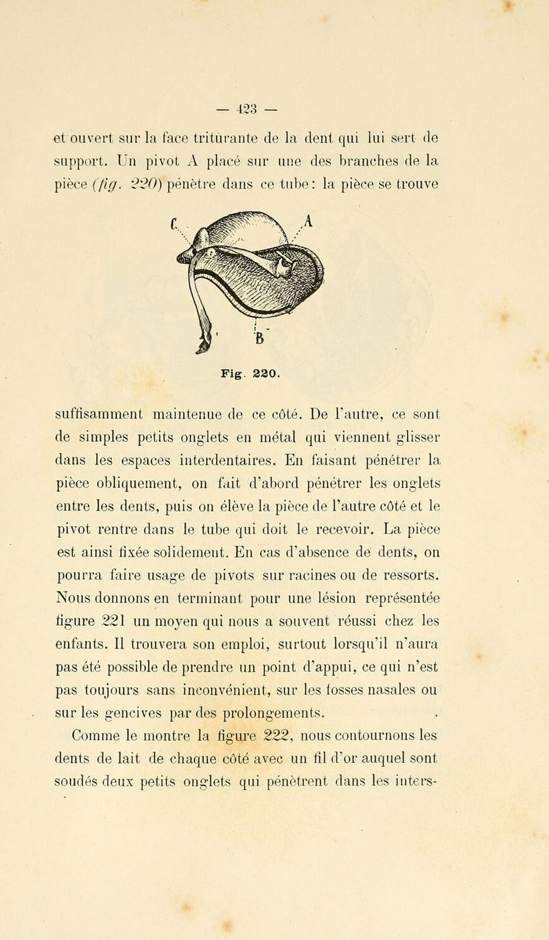 et ouvert sur la face triturante de la dent qui lui sert de support. Un pivot A placé sur une des branches de la pièce (fig. '2'20) pénètre dans ce tube: la pièce se trouve Fig. 220, suffisamment maintenue de ce côté. De l'autre, ce sont de simples petits onglets en métal qui viennent glisser dans les espaces interdentaires. En faisant pénétrer la pièce obliquement, on fait d'abord pénétrer les onglets entre les dents, puis on élève la pièce de l'autre côté et le pivot rentre dans le tube qui doit le recevoir. La pièce est ainsi fixée solidement. En cas d'absence de dents, on pourra faire usage de pivots sur racines ou de ressorts. Nous donnons en terminant pour une lésion représentée ligure 22\ un moyen qui nous a souvent réussi chez les enfants. Il trouvera son emploi, surtout lorsqu'il n'aura pas été possible de prendre un point d'appui, ce qui n'est pas toujours sans inconvénient, sur les losses nasales ou sur les gencives par des prolongements. Comme le montre la figure 222, nous contournons les dents de lait de chaque côté avec un fil d'or auquel sont soudés deux petits onglets qui pénètrent dans les iiiters-