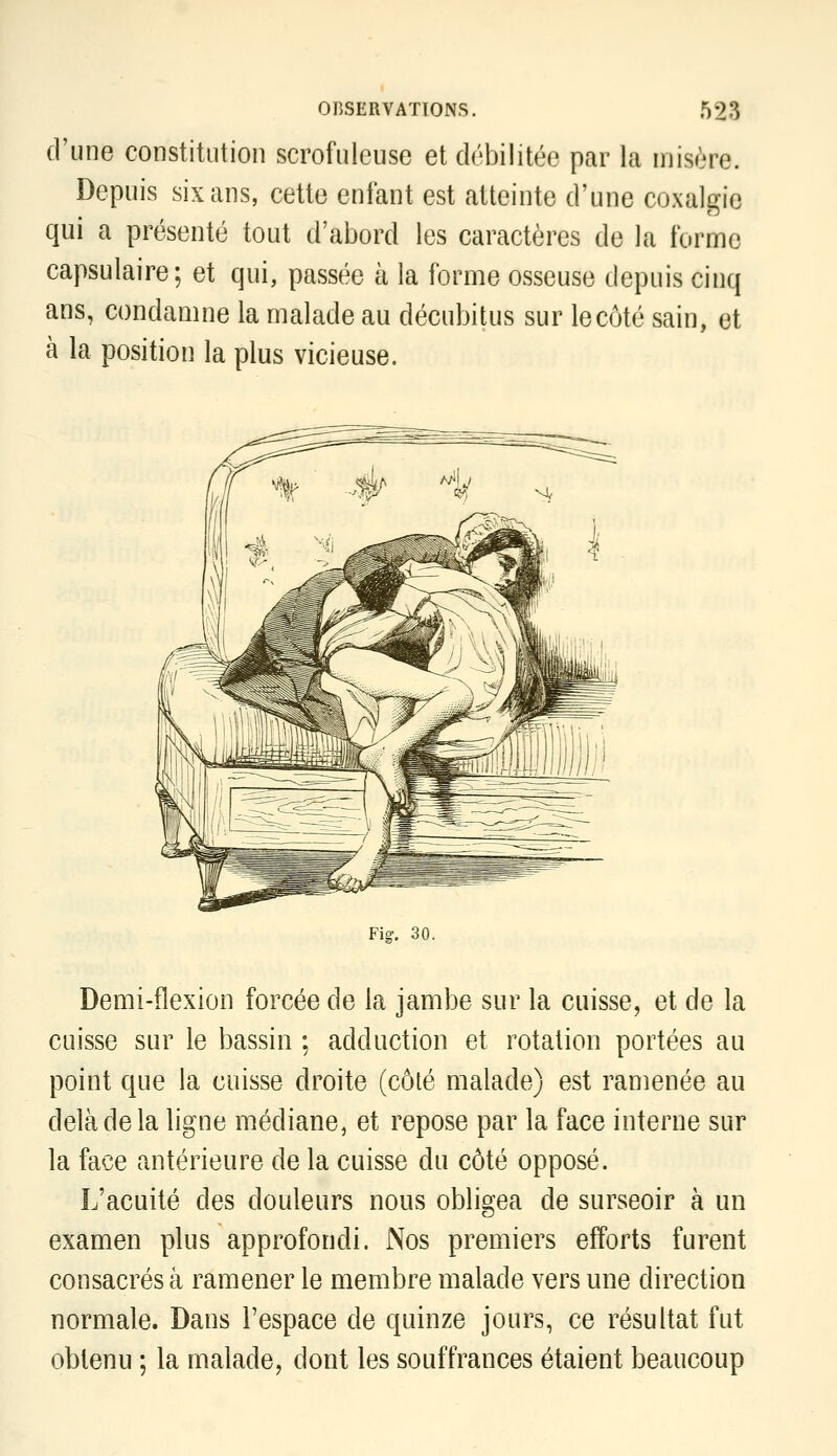 d'une constitution scrofuleuse et débilitée par la misère. Depuis six ans, cette enfant est atteinte d'une coxalgie qui a présenté tout d'abord les caractères de la forme capsulaire; et qui, passée à la forme osseuse depuis cinq ans, condamne la malade au décubitus sur le côté sain, et à la position la plus vicieuse. Fig-. 30. Demi-flexion forcée de la jambe sur la cuisse, et de la cuisse sur le bassin ; adduction et rotation portées au point que la cuisse droite (côté malade) est ramenée au delà de la ligne médiane, et repose par la face interne sur la face antérieure de la cuisse du côté opposé. L'acuité des douleurs nous obligea de surseoir à un examen plus approfondi. Nos premiers efforts furent consacrés à ramener le membre malade vers une direction normale. Dans l'espace de quinze jours, ce résultat fut obtenu ; la malade, dont les souffrances étaient beaucoup