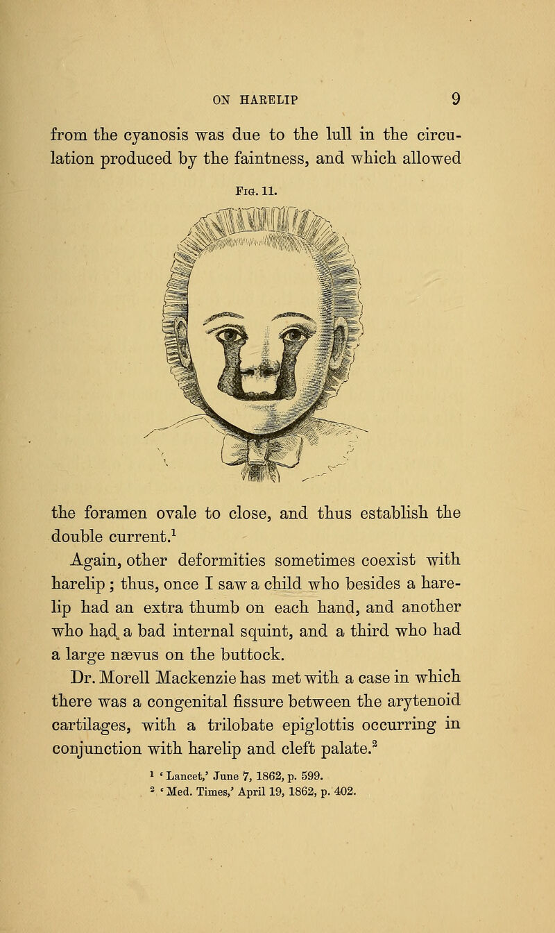 from the cyanosis was due to the lull in the circu- lation produced by the faintness, and which allowed the foramen ovale to close, and thus establish the double current.1 Again, other deformities sometimes coexist with harelip; thus, once I saw a child who besides a hare- lip had an extra thumb on each hand, and another who had. a bad internal squint, and a third who had a large naavus on the buttock. Dr. Morell Mackenzie has met with a case in which there was a congenital fissure between the arytenoid cartilages, with a trilobate epiglottis occurring in conjunction with harelip and cleft palate.2 1 ' Lancet,' June 7, 1862, p. 599. 2 ' Med. Times,5 April 19, 1862, p. 402.