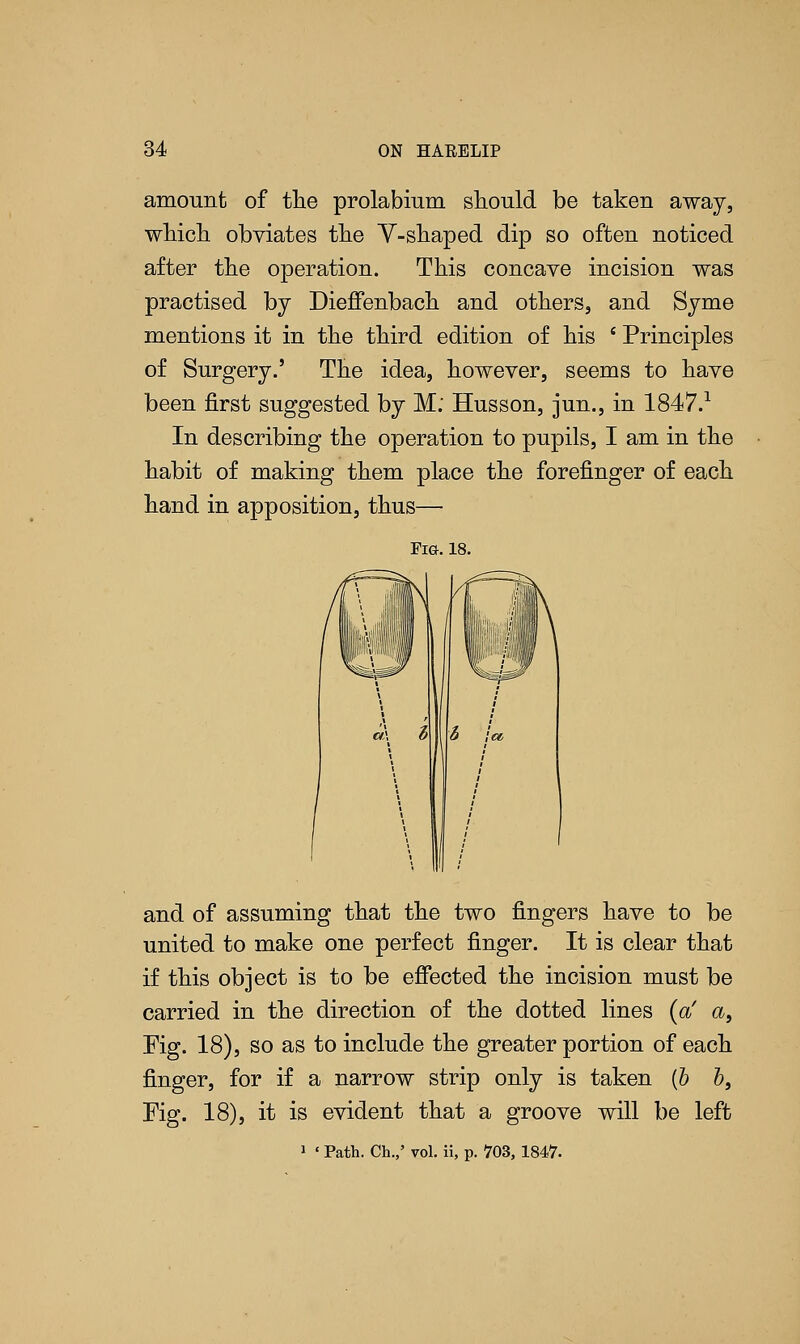 amount of the prolabium should be taken away, which obviates the Y-shaped dip so often noticed after the operation. This concave incision was practised by Dieffenbach and others, and Syme mentions it in the third edition of his ' Principles of Surgery.' The idea, however, seems to have been first suggested by M; Husson, jun., in 1847.1 In describing the operation to pupils, I am in the habit of making them place the forefinger of each hand in apposition, thus— Fig. 18. and of assuming that the two fingers have to be united to make one perfect finger. It is clear that if this object is to be effected the incision must be carried in the direction of the dotted lines {a' a, Fig. 18), so as to include the greater portion of each finger, for if a narrow strip only is taken (b b, Fig. 18), it is evident that a groove will be left > ' Path. Ch.,' vol. ii, p. 703, 1847-