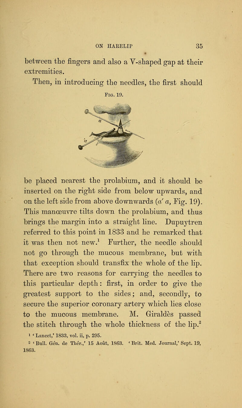 between the fingers and also a V-shaped gap at their extremities. Then, in introducing the needles, the first should Fig. 19. be placed nearest the prolabium, and it should be inserted on the right side from below upwards, and on the left side from above downwards (p! a, Fig. 19). This manoeuvre tilts down the prolabium, and thus brings the margin into a straight line. Dupuytren referred to this point in 1833 and he remarked that it was then not new.1 Further, the needle should not go through the mucous membrane, but with that exception should transfix the whole of the lip. There are two reasons for carrying the needles to this particular depth: first, in order to give the greatest support to the sides; and, secondly, to secure the superior coronary artery which lies close to the mucous membrane. M. Giraldes passed the stitch through the whole thickness of the lip.2 1 * Lancet,' 1833, vol. ii, p. 295. 2 ' Bull. Gen. de Ther.,' 15 Aout, 1863. * Brit. Med. Journal,' Sept. 19, 1863.