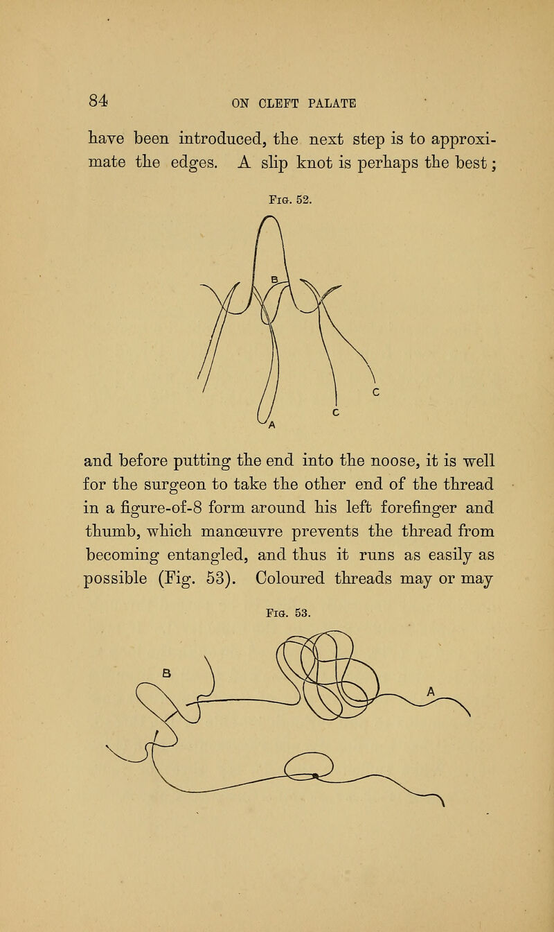 have been introduced, the next step is to approxi- mate the edges. A slip knot is perhaps the best; Fig. 52. and before putting the end into the noose, it is well for the surgeon to take the other end of the thread in a figure-of-8 form around his left forefinger and thumb, which manoeuvre prevents the thread from becoming entangled, and thus it runs as easily as possible (Fig. 53). Coloured threads may or may Fig. 53.