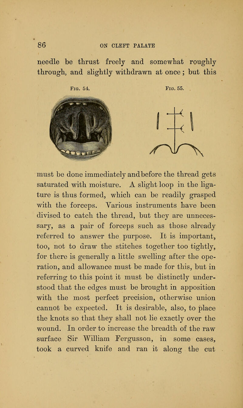 needle be thrust freely and somewhat roughly through, and slightly withdrawn at once; but this Fig. 54. Fig. 55. must be done immediately and before the thread gets saturated with moisture. A slight loop in the liga- ture is thus formed, which can be readily grasped with the forceps. Various instruments have been divised to catch the thread, but they are unneces- sary, as a pair of forceps such as those already referred to answer the purpose. It is important, too, not to draw the stitches together too tightly, for there is generally a little swelling after the ope- ration, and allowance must be made for this, but in referring to this point it must be distinctly under- stood that the edges must be brought in apposition with the most perfect precision, otherwise union cannot be expected. It is desirable, also, to place the knots so that they shall not lie exactly over the wound. In order to increase the breadth of the raw surface Sir William Eergusson, in some cases, took a curved knife and ran it along the cut