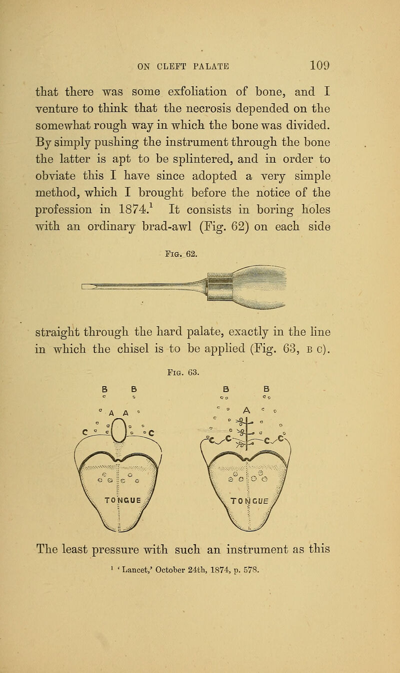 that there was some exfoliation of bone, and I venture to think that the necrosis depended on the somewhat rough way in which the bone was divided. By simply pushing the instrument through the bone the latter is apt to be splintered, and in order to obviate this I have since adopted a very simple method, which I brought before the notice of the profession in 1874.1 It consists in boring holes with an ordinary brad-awl (Fig. 62) on each side Fig. 62. straight through the hard palate, exactly in the line in which the chisel is to be applied (Fig. 63, b c). Fig. 63. The least pressure with such an instrument as this