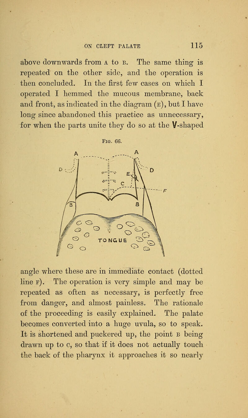 above downwards from a to B. The same thing is repeated on the other side, and the operation is then concluded. In the first few cases on which I operated I hemmed the mucous membrane, back and front, as indicated in the diagram (e) , but I have long since abandoned this practice as unnecessary, for when the parts unite they do so at the V-shaped Fig. 66. angle where these are in immediate contact (dotted line f). The operation is very simple and may be repeated as often as necessary, is perfectly free from danger, and almost painless. The rationale of the proceeding is easily explained. The palate becomes converted into a huge uvula, so to speak. It is shortened and puckered up, the point b being drawn up to o, so that if it does not actually touch the back of the pharynx it approaches it so nearly