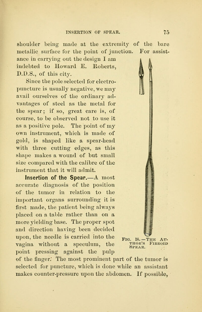 shoulder being made at the extremity of the bare metallic surface for the point of junction. For assist- ance in carrying out the design I am indebted to Howard E. Roberts, D.D.S., of this city. Since the pole selected for electro- puncture is usually negative, we may avail ourselves of the ordinary ad- vantages of steel as the metal for the spear; if so, great care is, of course, to be observed not to use it as a positive pole. The point of my own instrument, which is made of gold, is shaped like a spear-head with three cutting edges, as this shape makes a wound of but small size compared with the calibre of the instrument that it will admit. Insertion of the Spear.—A most accurate diagnosis of the position of the tumor in relation to the important organs surrounding it is first made, the patient being always placed on a table rather than on a more yielding base. The proper spot and direction having been decided upon, the needle is carried into the vagina without a speculum, the point pressing against the pulp of the finger. The most prominent part of the tumor is selected for puncture, which is done while an assistant makes counter-pressure upon the abdomen. If possible, Fig. 18.—The Au- thor's Fibroid Spear.