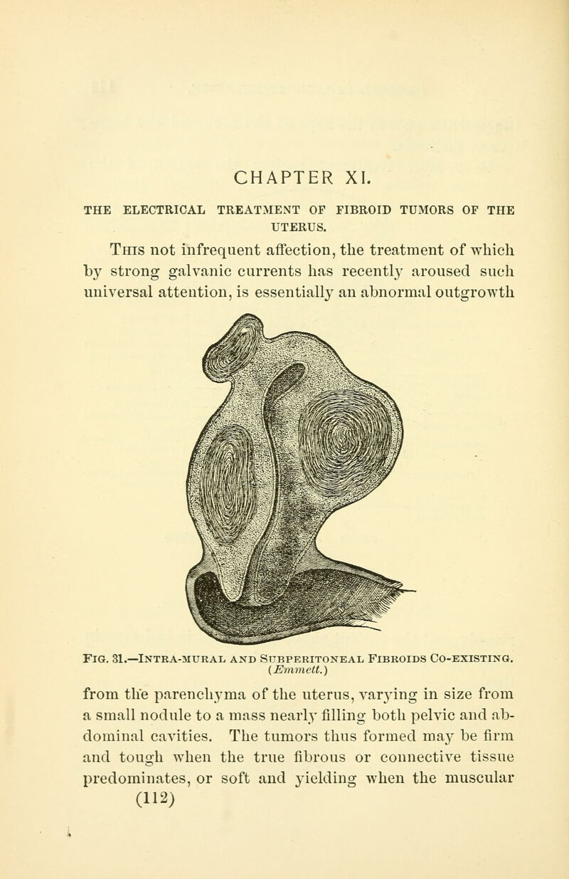 CHAPTER XI. THE ELECTRICAL TREATMENT OF FIBROID TUMORS OF THE UTERUS. This not infrequent affection, the treatment of which by strong galvanic currents has recently aroused such universal attention, is essentially an abnormal outgrowth Fig. 31.—Intra-mural, and Subperitoneal, Fibroids Co-existing. (Emmett.) from the parenchyma of the uterus, varjdng in size from a small nodule to a mass nearly filling both pelvic and ab- dominal cavities. The tumors thus formed may be firm and tough when the true fibrous or connective tissue predominates, or soft and yielding when the muscular