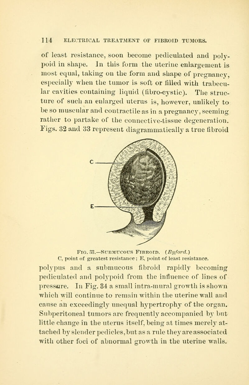 of least resistance, soon become pediculated and poly- poid in shape. In this form the uterine enlargement is most equal, taking on the form and shape of pregnancy, especially when the tumor is soft or filled with trabecu- lar cavities containing liquid (fibro-cystic). The struc- ture of such an enlarged uterus is, however, unlikely to be so muscular and contractile as in a pregnane}', seeming rather to partake of the connective-tissue degeneration. Figs. 32 and 33 represent diagrammatically a true fibroid Fig. 33.—Submucous Fibroid. (By/ord.) C, point of greatest resistance ; E, point of least resistance. polypus and a submucous fibroid rapidty becoming pediculated and potypoid from the influence of lines of pressure. In Fig. 34 a small intra-mural growth is shown which will continue to remain within the uterine wall and cause an exceedingly unequal hypertrophy of the organ. Subperitoneal tumors are frequently accompanied by but little change in the uterus itself, being at times merely at- tached b}r slender pedicles,but as a rule they are associated with other foci of abnormal growth in the uterine walls.