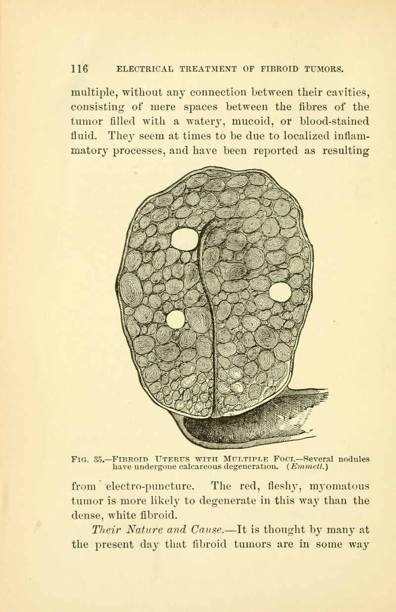 multiple, without any connection between their cavities, consisting of mere spaces between the fibres of the tumor filled with a watery, mucoid, or blood-stained fluid. The}' seem at times to be due to localized inflam- matory processes, and have been reported as resulting Fig. 3d.—Fibroid Uterus with Multtpi.e Foct.—Several nodules have undergone calcareous degeneration. (Emmell.) from electro-puncture. The red, fleshy, nryomatous tumor is more likely to degenerate in this wa}T than the dense, white fibroid. Their Nature and Cause.—It is thought by many at the present day that fibroid tumors are in some way
