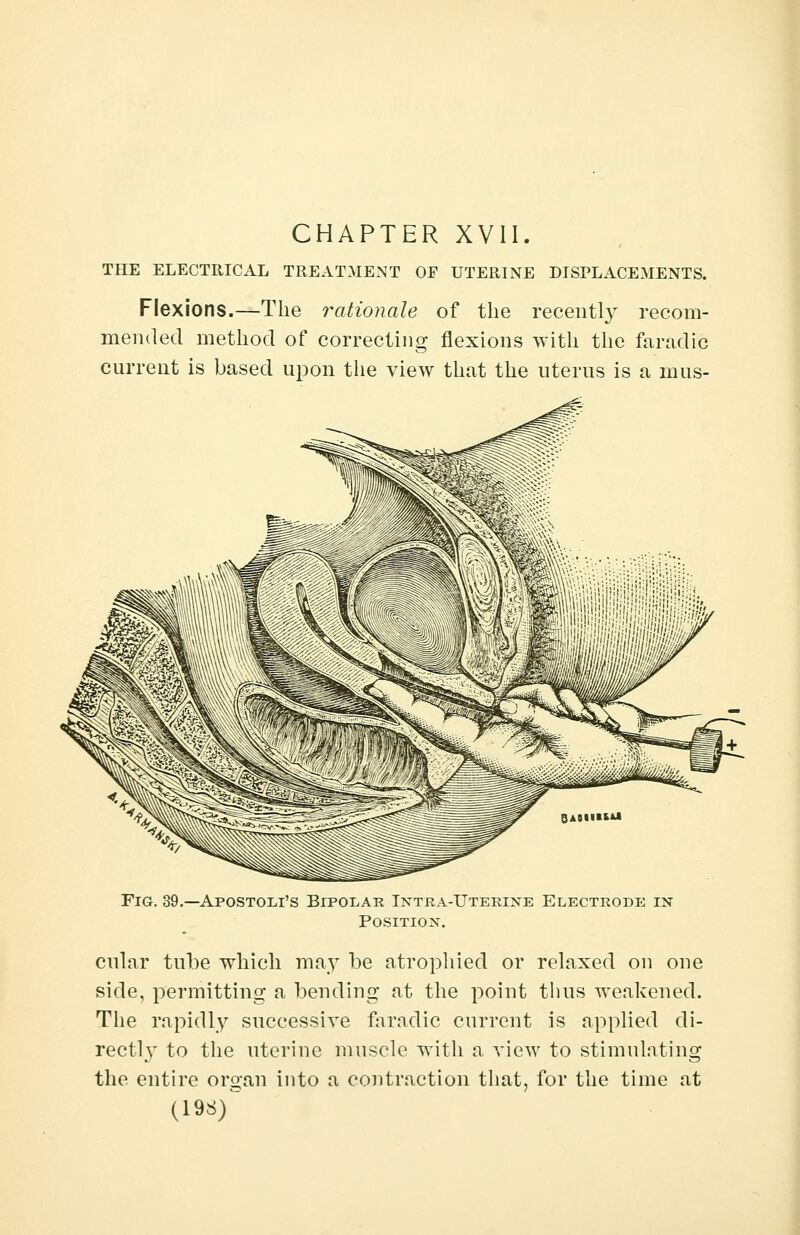 CHAPTER XVII. THE ELECTRICAL TREATMENT OF UTERINE DISPLACEMENTS. Flexions.—The rationale of the recently recom- mended method of correcting flexions with the faradic current is based upon the view that the uterus is a mus- FlG. 39. -Apostolus Bipolar Intra-Uteriste Electrode in Position. cular tube which may be atrophied or relaxed on one side, permitting a bending at the point thus weakened. The rapidly successive faradic current is applied di- rectly to the uterine muscle with a view to stimulating the entire organ into a contraction that, for the time at