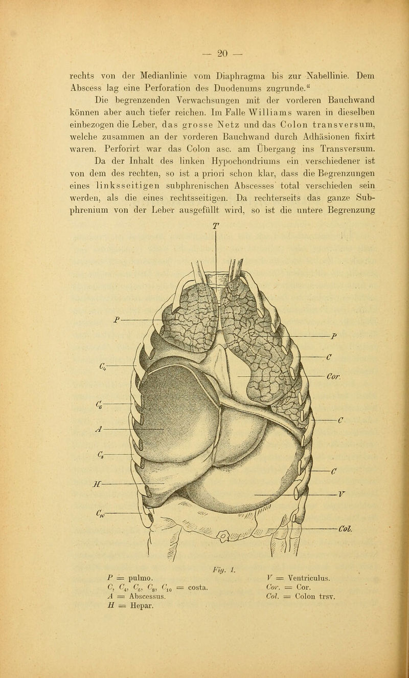rechts von der Medianlinie vom Diaphragma bis zur Nabellinie. Dem Abscess lag eine Perforation des Duodenums zugrunde. Die begrenzenden Verwachsungen mit der vorderen Bauchwand können aber auch tiefer reichen. Im Falle Williams waren in dieselben einbezogen die Leber, das grosse Netz und das Colon transversum, welche zusammen an der vorderen Bauchwand durch Adhäsionen fixirt waren. Perforirt war das Colon asc. am Übergang ins Transversum. Da der Inhalt des linken Hypochondriums ein verschiedener ist von dem des rechten, so ist a priori schon klar, dass die Begrenzungen eines linksseitigen subphrenischen Abscesses' total verschieden sein werden, als die eines rechtsseitigen. Da rechterseits das ganze Sub- phrenium von der Leber ausgefüllt wird, so ist die untere Begrenzung T P = pulmo. G, C'4, Cg, Cg, 6% == Costa. A = Abscessus. H = Hepar. Fiy. 1. V :== Ventriculus. Cor. = Cor. Col. := Colon trsv.