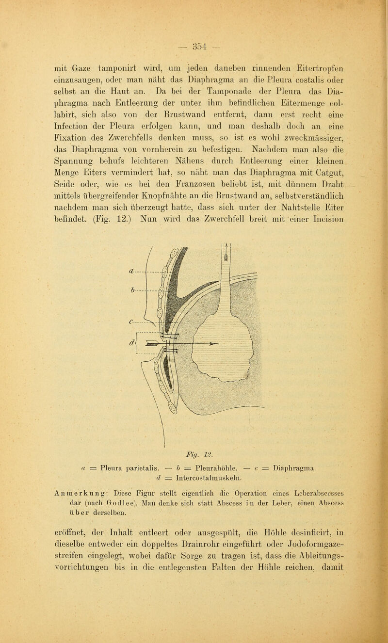 mit Gaze tamponirt wird, um jeden daneben rinnendeii Eitertrnpfen einzusaugen, oder man näht das Diaphragma an die Pleura costalis oder selbst an die Haut an. Da bei der Tamponade der Pleura das Dia- phragma nach Entleerung der unter ihm befindlichen Eitermenge col- labirt, sich also von der Brustwand entfernt, dann erst recht eine Infection der Pleura erfolgen kann, und man deshalb doch an eine Fixation des Zwerchfells denken muss, so ist es wohl zweckmässiger, das Diaphragma von vornherein zu befestigen. Nachdem man also die Spannung behufs leichteren Nähens durch Entleerung einer kleinen Menge Eiters vermindert hat, so näht man das Diaphragma mit Catgut, Seide oder, wie es bei den Franzosen behebt ist, mit dünnem Draht mittels übergreifender Knopfnähte an die Brustwand an, selbstverständlich nachdem man sich überzeugt hatte, dass sich unter der Nahtstelle Eiter befindet. (Fig. 12.) Nun wird das Zwerchfell breit mit einer Incision Fi(j. 12. a = Pleura parietalis. — h = Pleurahöhle. — c = Diaphragma. d = Intercostalmuskeln. Anmerkung: Diese Figur stellt eigentlich die Operation eines Leberabscesses dar (nach Godlee). Man denke sich statt Abscess in der Leber, einen Abscess über derselben. eröffnet, der Inhalt entleert oder ausgespült, die Höhle desinficirt, in dieselbe entweder ein doppeltes Drainrohr eingeführt oder Jodoformgaze- streifen eingelegt, wobei dafür Sorge zu tragen ist, dass die Ableitungs- vorrichtungen bis in die entlegensten Falten der Höhle reichen, damit