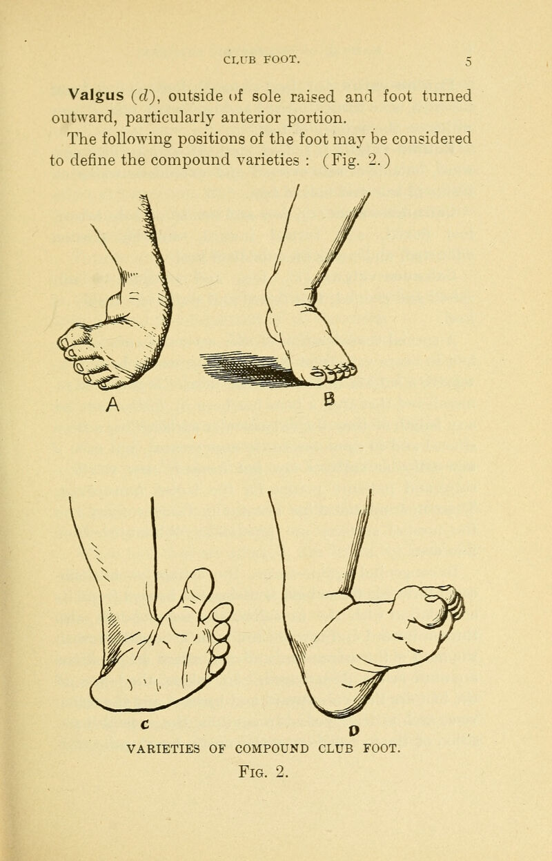 Valgus (c/), outside of sole raised and foot turned outward, particularly anterior portion. The following positions of the foot may be considered to define the compound varieties : (Fig. 2.) varieties of compound club foot.