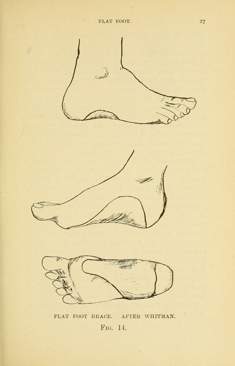 flat foot brace. after whitman. Fig. 14.