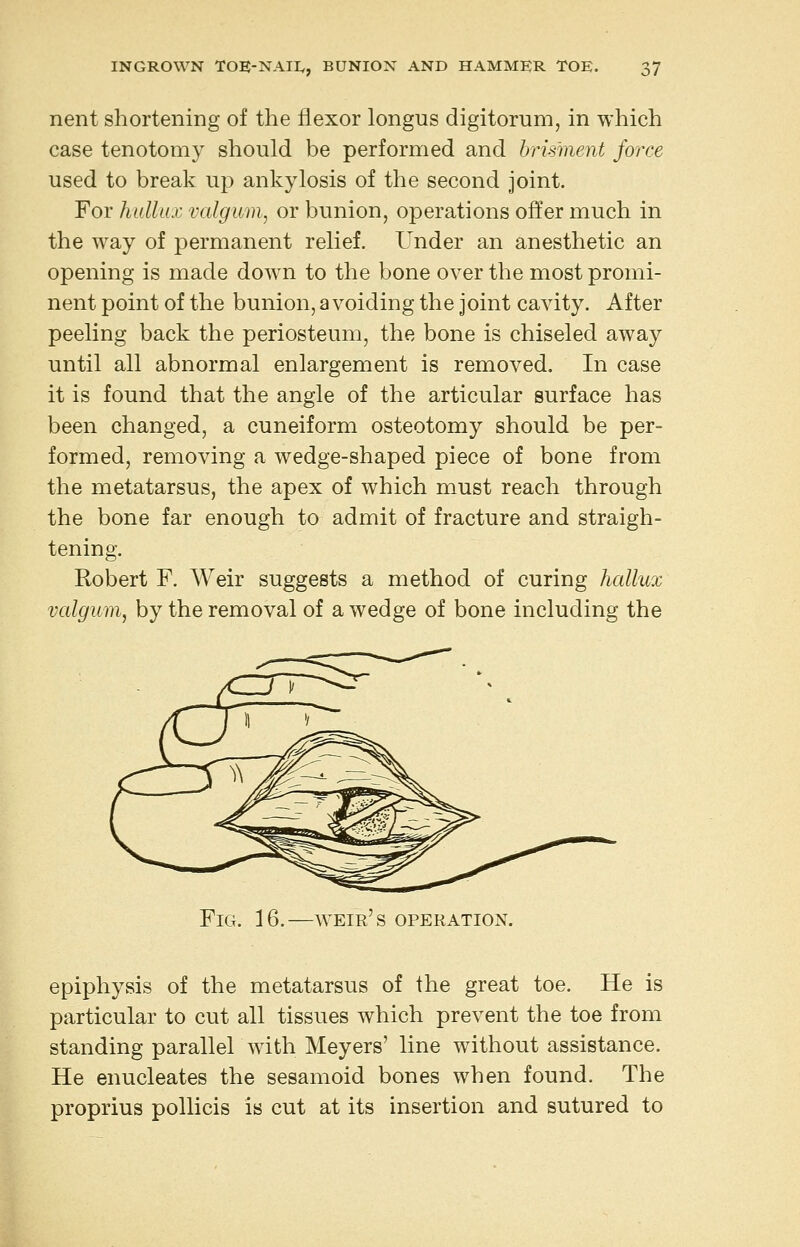 nent shortening of the flexor longus digitorum, in which case tenotomy should be performed and hrisment force used to break up ankylosis of the second joint. For hallux valgum^ or bunion, operations offer much in the way of permanent relief. Under an anesthetic an opening is made down to the bone over the most promi- nent point of the bunion, a voiding the joint cavity. After peeling back the periosteum, the bone is chiseled away until all abnormal enlargement is removed. In case it is found that the angle of the articular surface has been changed, a cuneiform osteotomy should be per- formed, removing a wedge-shaped piece of bone from the metatarsus, the apex of which must reach through the bone far enough to admit of fracture and straigh- tening. Robert F. Weir suggests a method of curing hallux valgum, by the removal of a wedge of bone including the Fig. 16.—aveir's operation. epiphysis of the metatarsus of the great toe. He is particular to cut all tissues which prevent the toe from standing parallel with Meyers' line without assistance. He enucleates the sesamoid bones when found. The proprius pollicis is cut at its insertion and sutured to