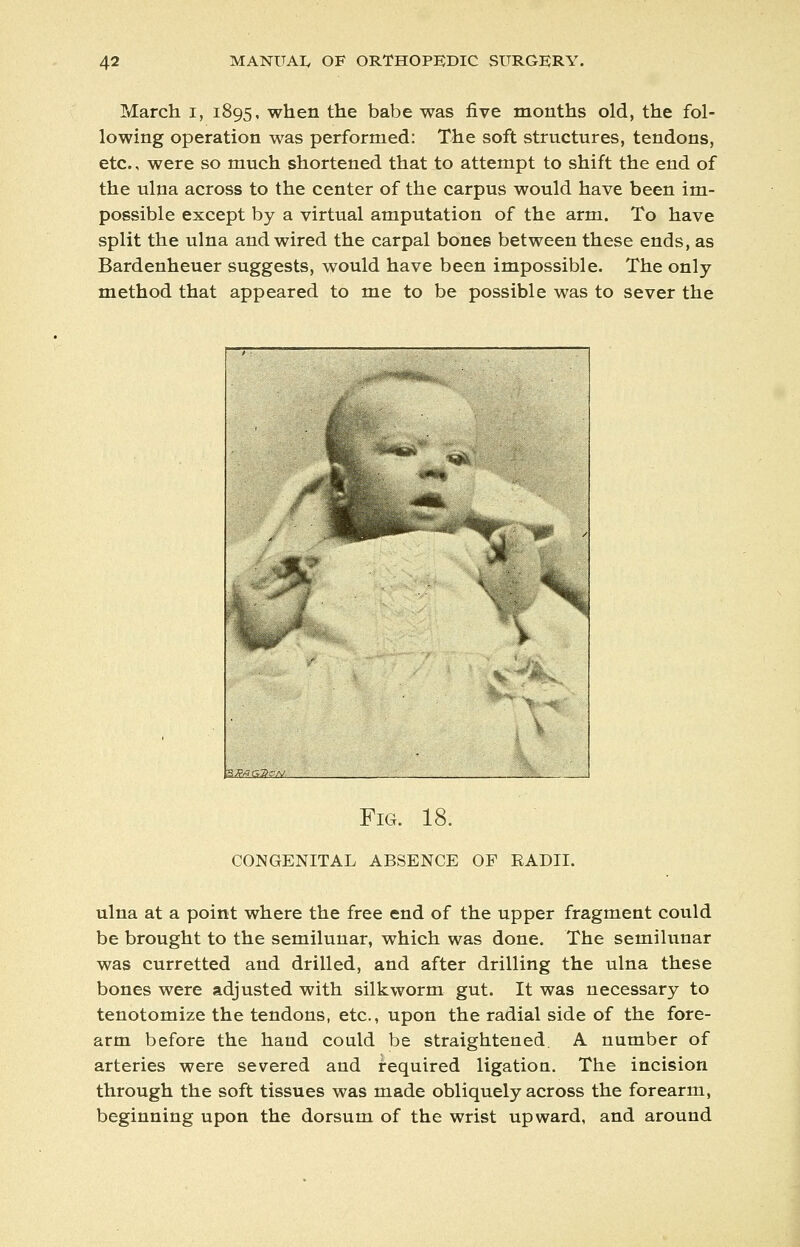 March i, 1895, when the babe was five months old, the fol- lowing operation was performed: The soft structures, tendons, etc., were so much shortened that to attempt to shift the end of the ulna across to the center of the carpus would have been im- possible except by a virtual amputation of the arm. To have split the ulna and wired the carpal bones between these ends, as Bardenheuer suggests, would have been impossible. The only- method that appeared to me to be possible was to sever the m ,5 H^ Fig. 18. congenital absence of radii. ulna at a point where the free end of the upper fragment could be brought to the semilunar, which was done. The semilunar was curretted and drilled, and after drilling the ulna these bones were adjusted with silkworm gut. It was necessary to tenotomize the tendons, etc., upon the radial side of the fore- arm before the hand could be straightened. A number of arteries were severed and required ligation. The incision through the soft tissues was made obliquely across the forearm, beginning upon the dorsum of the wrist upward, and around