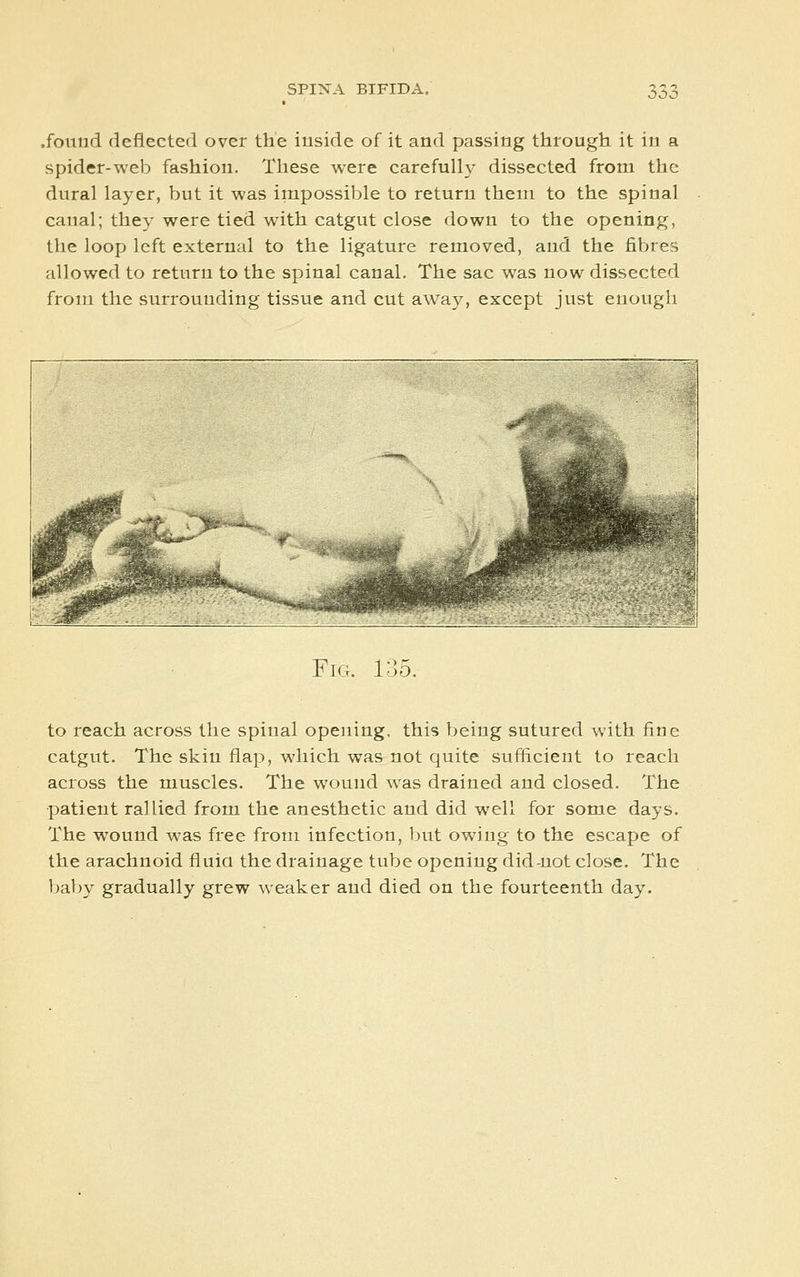 .found deflected over the iuside of it and passing through it in a spider-web fashion. These were carefully dissected from the dural layer, but it was impossible to return them to the spinal canal; they were tied with catgut close down to the opening, the loop left external to the ligature removed, and the fibres allowed to return to the spinal canal. The sac was now dissected from the surrounding tissue and cut away, except just enough Fig. 135. to reach across the spinal opening, this being sutured with fine catgut. The skin flap, which was not quite sufficient to reach across the muscles. The wound was drained and closed. The patient rallied from the anesthetic and did well for some days. The wound was free from infection, Ijut owing to the escape of the arachnoid fluia the drainage tube opening did-not close. The baby gradually grew weaker and died on the fourteenth day.