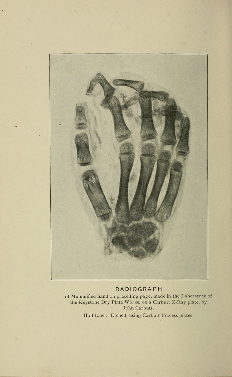 RADIOGRAPH of Mummified hand on preceding page, made in the Laboratory of the Keystone Dry Plate Works, on a Carbutt X-Ray plate, by John Carbutt.