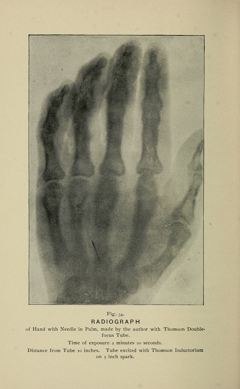 IBS Fig- 34- RADIOGRAPH of Hand with Needle in Palm, made by the author with Thomson Double- focus Tube. Time of exposure 2 minutes 20 seconds. Distance from Tube 10 inches. Tube excited with Thomson Inductorium