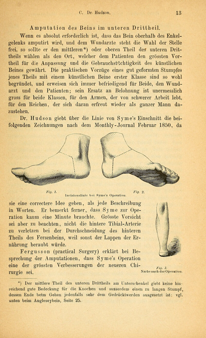 Amputation des Beins im unteren Drittheil. Wenn es absolut erforderlich ist, dass das Bein oberhalb des Enkel- gelenks amputirt wird, und dem Wundarzte steht die Wahl der Stelle frei, so sollte er den mittleren*) oder oberen Theil des unteren Drit- theils wählen als den Ort, welcher dem Patienten den grössten Vor- theil für die Anpassung und die Gebrauchstüchtigkeit des künstlichen Beines gewährt. Die praktischen Vorzüge eines gut geformten Stumpfes jenes Theils mit einem künstlichen Beine erster Klasse sind so wohl begründet, und erweisen sich immer befriedigend für Beide, den Wund- arzt und den Patienten; sein Ersatz an Belohnung ist unermesslich gross für beide Klassen, für den Armen, der von schwerer Arbeit lebt, für den Kelchen, der sich daran erfreut wieder als ganzer Mann da- zustehen. Dr. Hudson giebt über die Linie von Syme's Einschnitt die bei- folgenden Zeichnungen nach dem Monthly-Journal Februar 1850, da Fig. 1. Incisioiislinie bei vSyme's Operation. Fig. 2. sie eine correctere Idee geben, als jede Beschreibung in Worten. Er bemerkt ferner, dass S3^me zur Ope- ration kaum eine Minute brauchte. Grösste Vorsicht sei aber zu beachten, nicht die hintere Tibial-Arterie zu verletzen bei der Durchschneidung des hinteren Theils des Fersenbeins, weil sonst der Lappen der Er- nährung beraubt würde. Fergusson (practical Surgery) erklärt bei Be- sprechung der Amputationen, dass Syme's Operation eine der grössten Verbesserungen der neueren Chi- rurgie sei. Fig. 3. Narbe nach der Operation. *) Der mittlere Theil des unteren Drittheils am Unterschenkel giebt keine hin- reichend gute Bedeckung für die Knochen und ausserdem einen zu langen Stumpf, dessen Ende betm Gehen jedenfalls sehr dem Gedrücktwerden ausgesetzt ist; vgl. unten beim Angleseybein, Seite 25.