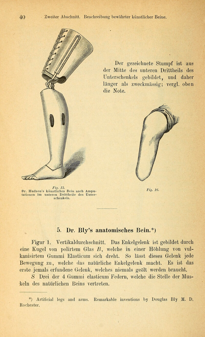 Der gezeichnete Stumpf ist aus der Mitte des unteren Drittheils des Unterschenkels gebildet, und daher länger als zweckmässig; vergl. oben die Note. Fig. 15. Dr. Hudsou's künstliches Bein nach Ampu- tationen im unteren Drittheile des Unter- schenkels. Fig. 16. 5. Dr. Bly's anatomisches Bein.*) Figur 1, Vertikaldurchschnitt. Das Enkelgelenk ist gebildet durch eine Kugel von polirtem Glas B, welche in einer Höhlung von vul- kanisirtem Gummi Elasticum sich dreht. So lässt dieses Gelenk jede Bewegung zu, welche das natürliche Enkelgelenk macht. Es ist das erste jemals erfundene Gelenk, welches niemals geölt werden braucht, S Drei der 4 Gummi elasticum Federn, welche die Stelle der Mus- keln des natürlichen Beins vertreten. *) Artificial legs and arms. Remarkable inventions by Douglas Bly M. D. Rochester.